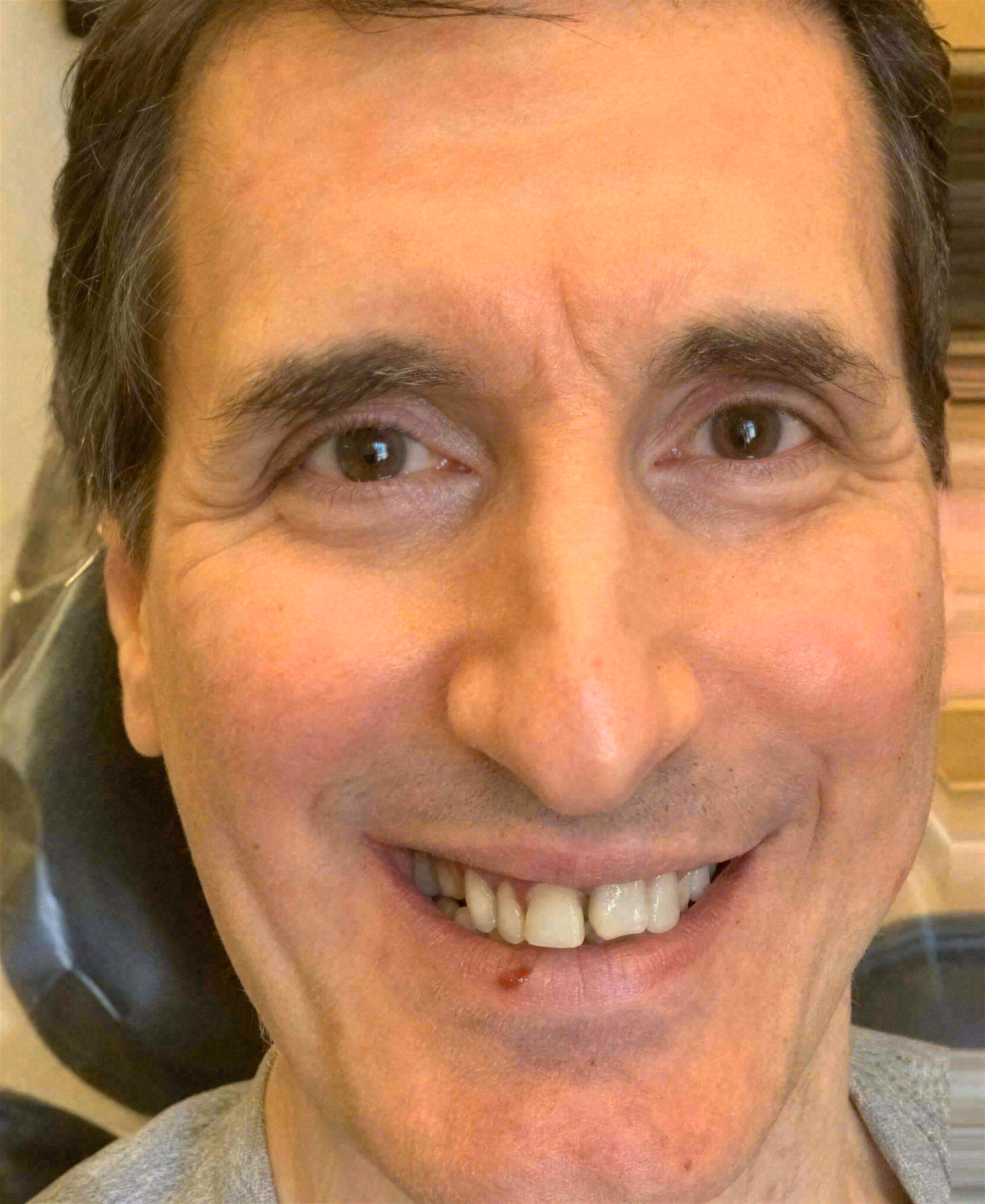 Before dental implants at Sola Dental Spa