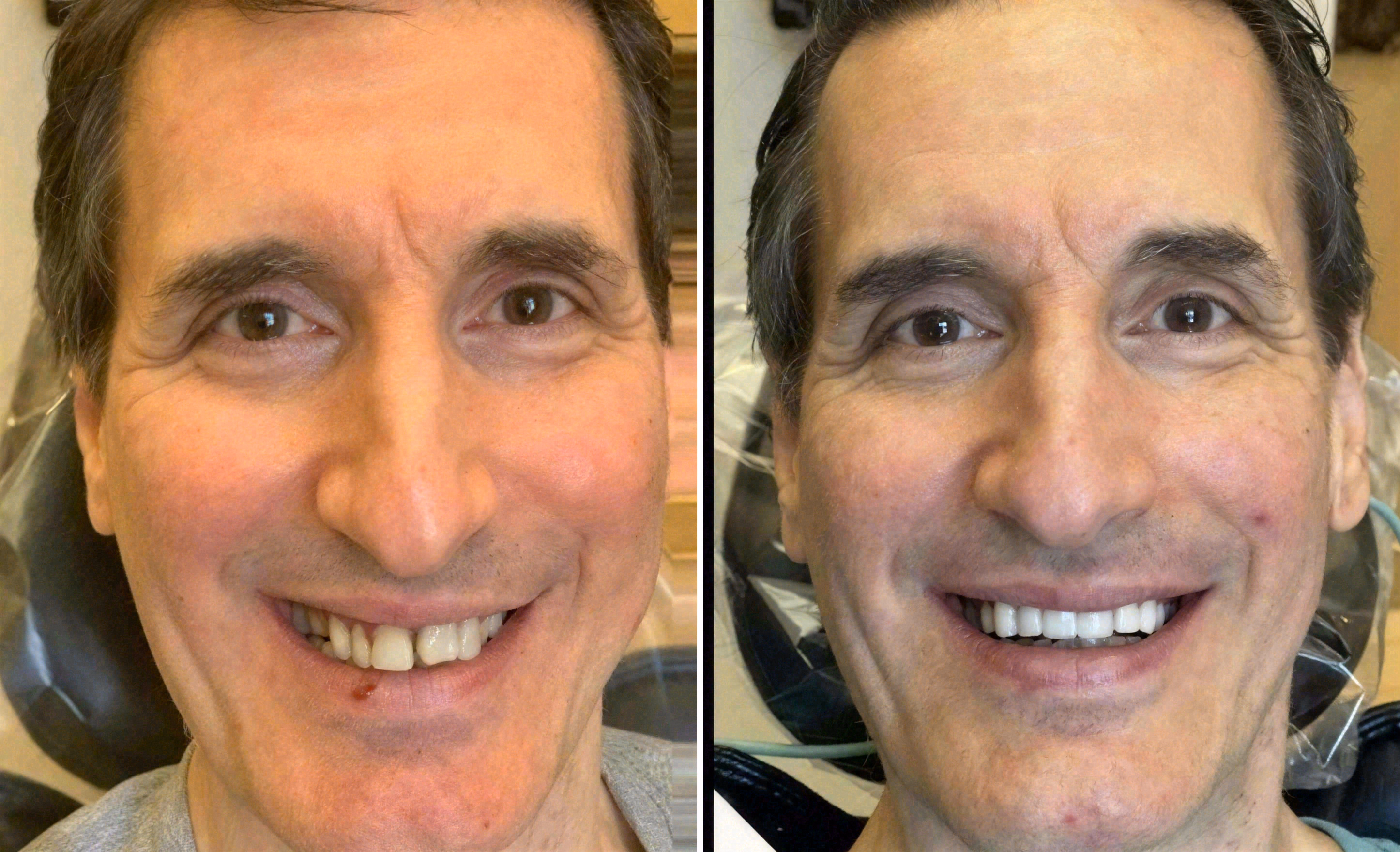 Before and after: dental implants and veneers case at Sola Dental Spa