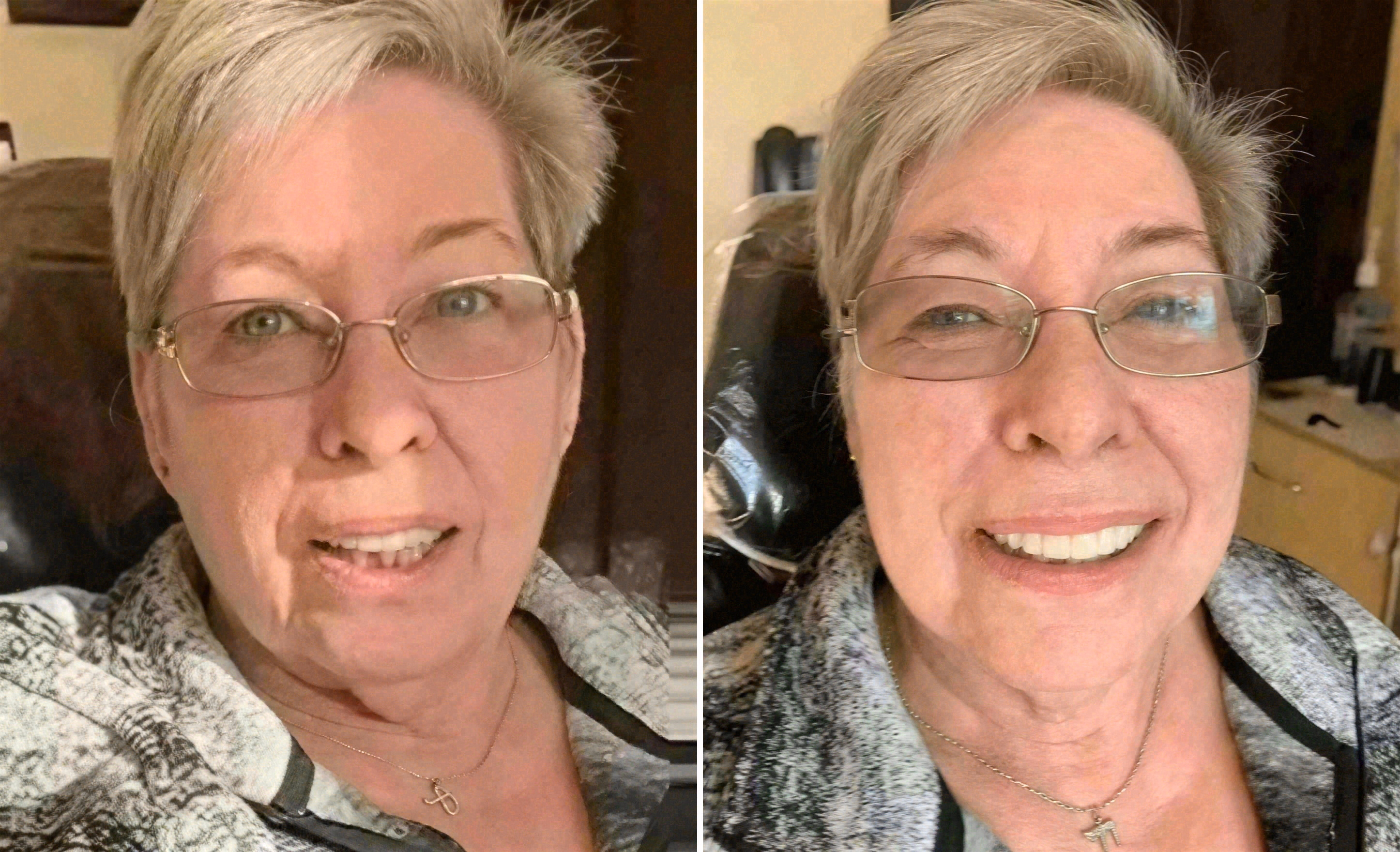 Before and after: dental implants case at Sola Dental Spa