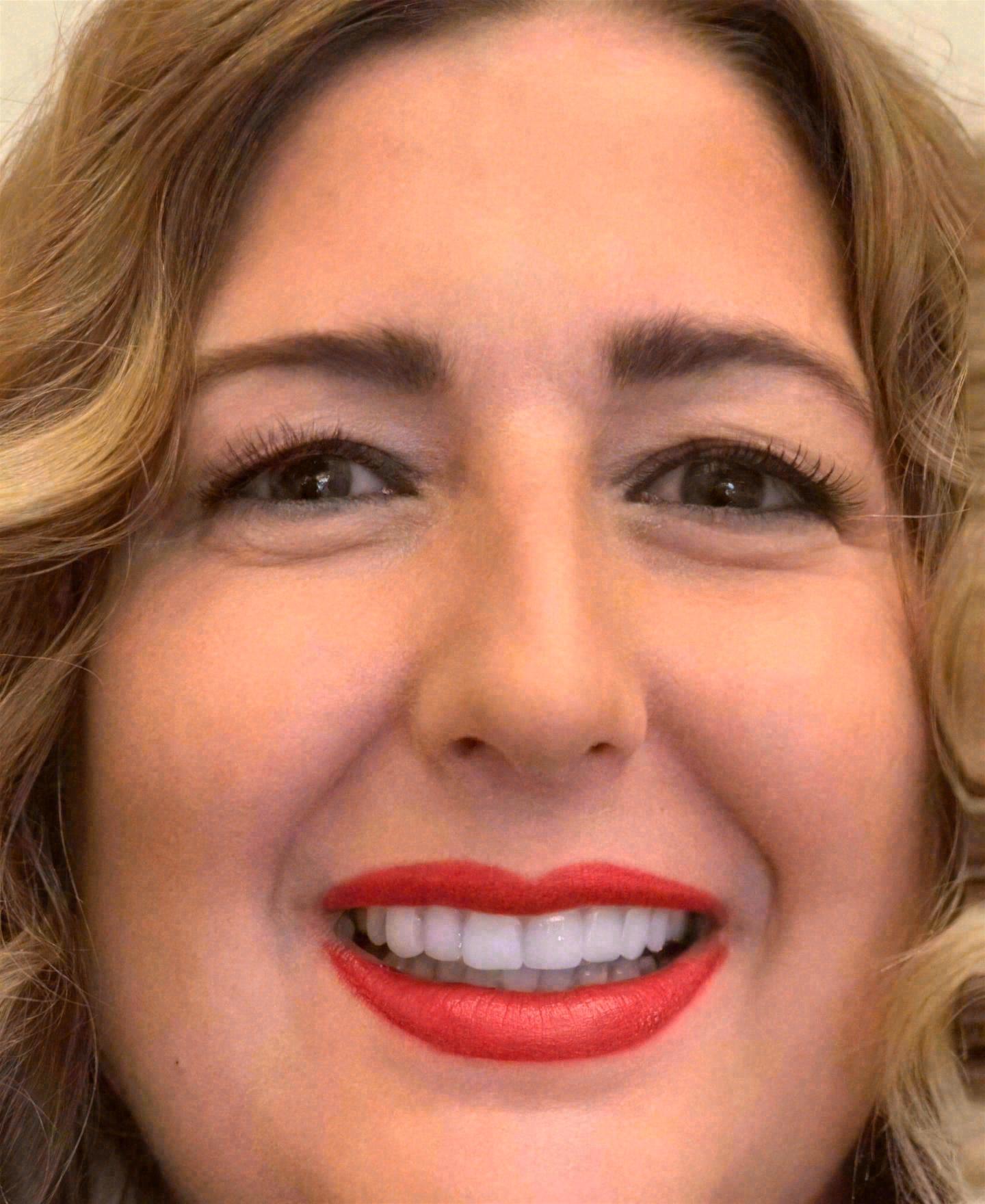 After porcelain veneers at Sola Dental Spa