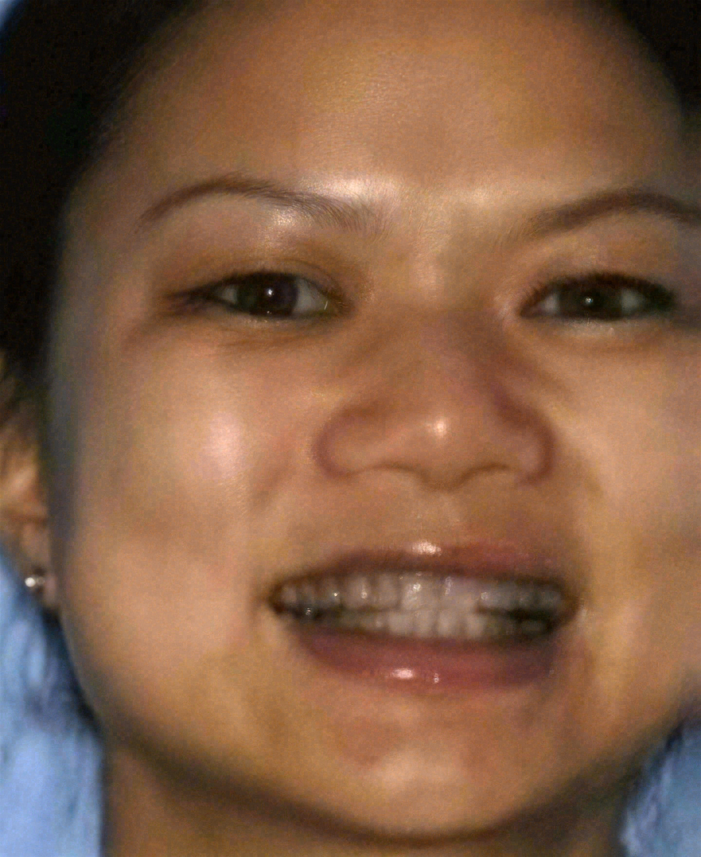 Before porcelain veneers at Sola Dental Spa