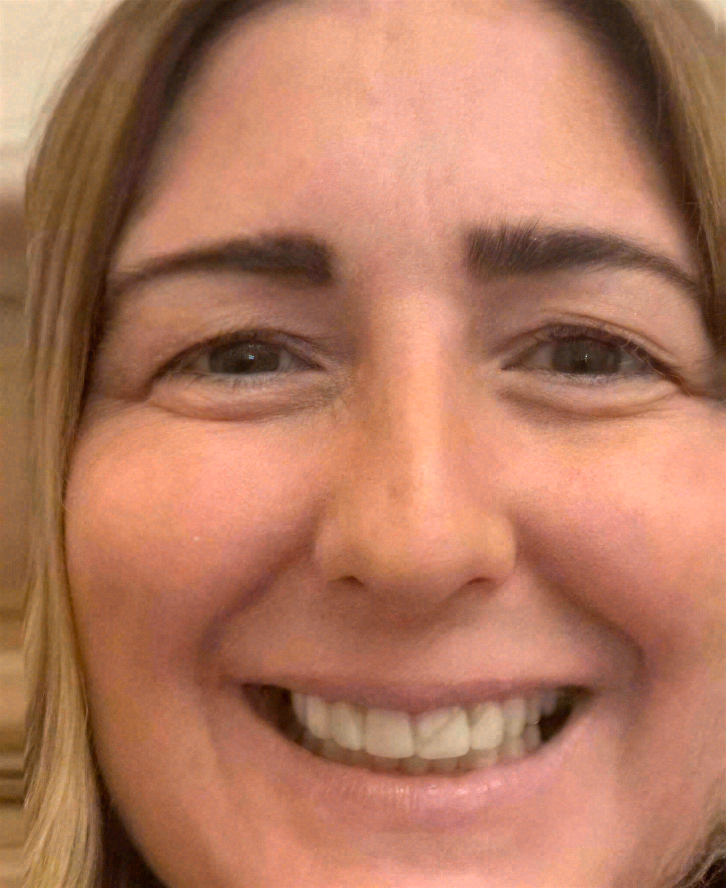Before porcelain veneers at Sola Dental Spa