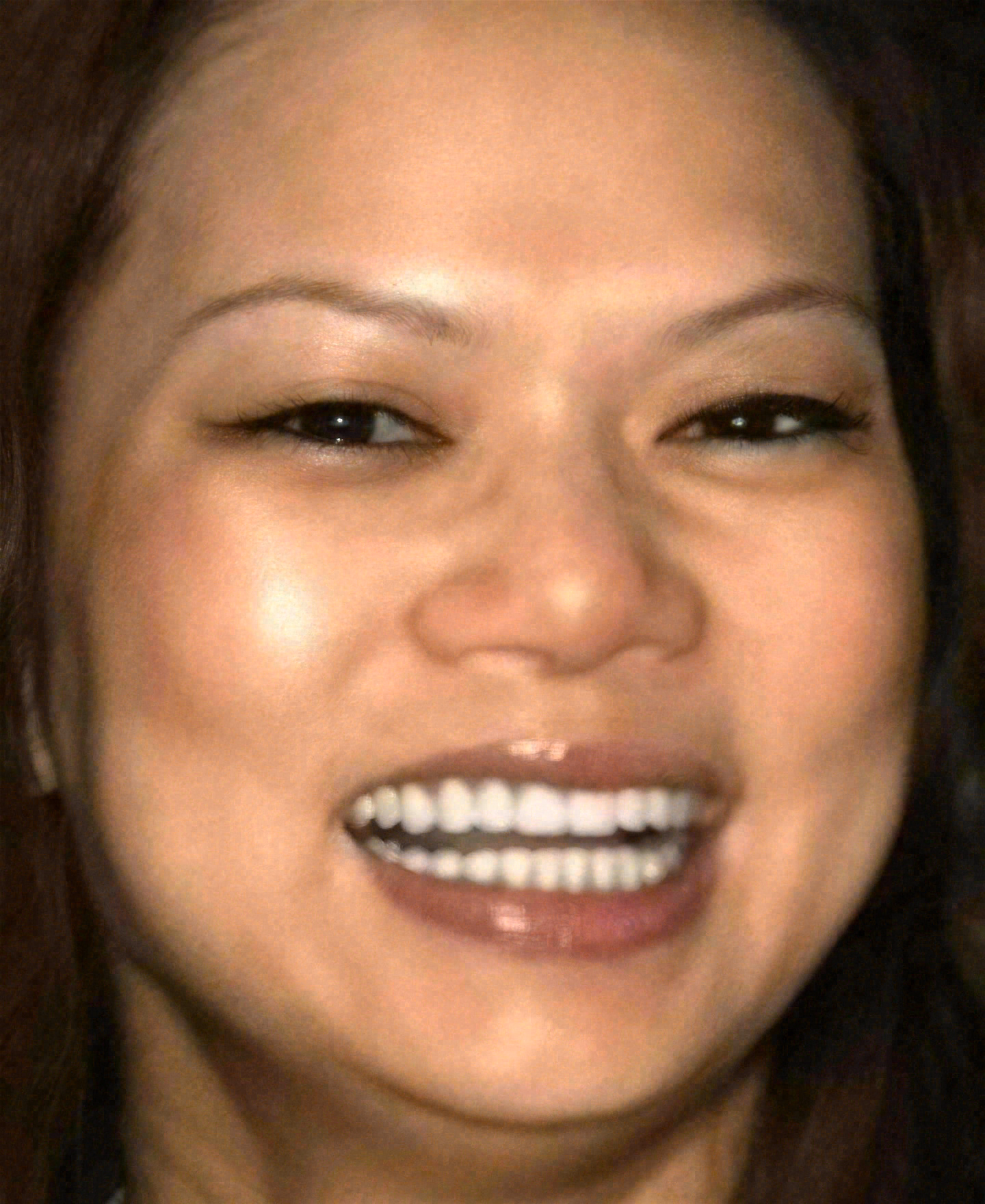 After porcelain veneers at Sola Dental Spa