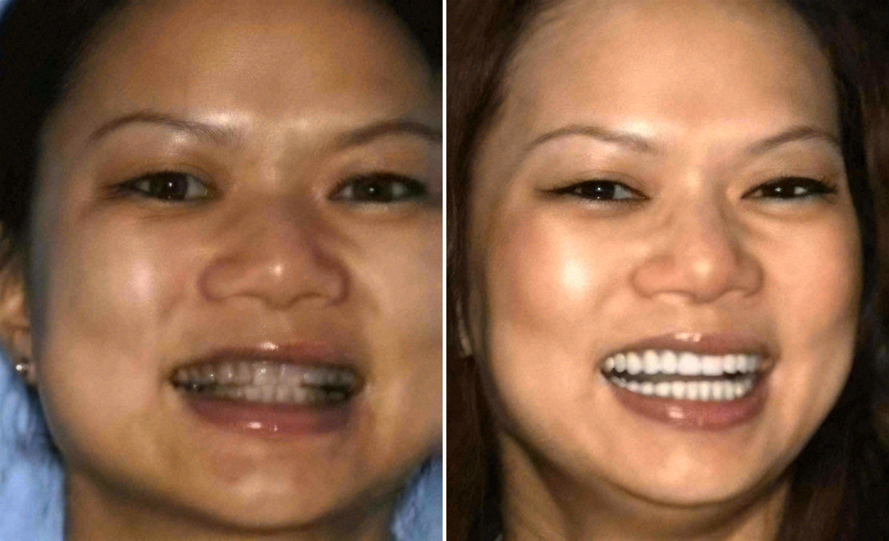Before and after: porcelain veneers covering tetracycline staining at Sola Dental Spa