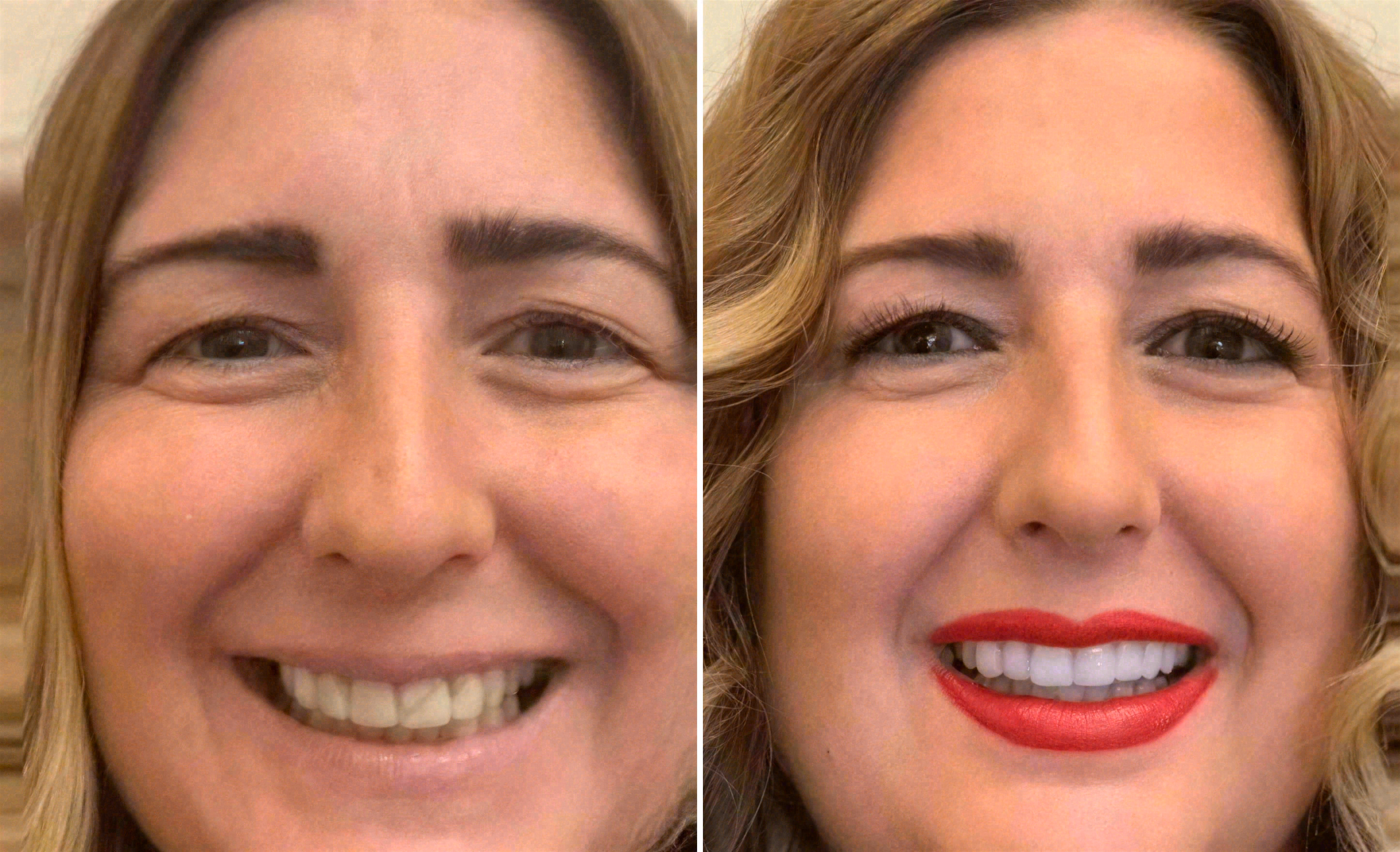 Before and after: porcelain veneers case at Sola Dental Spa