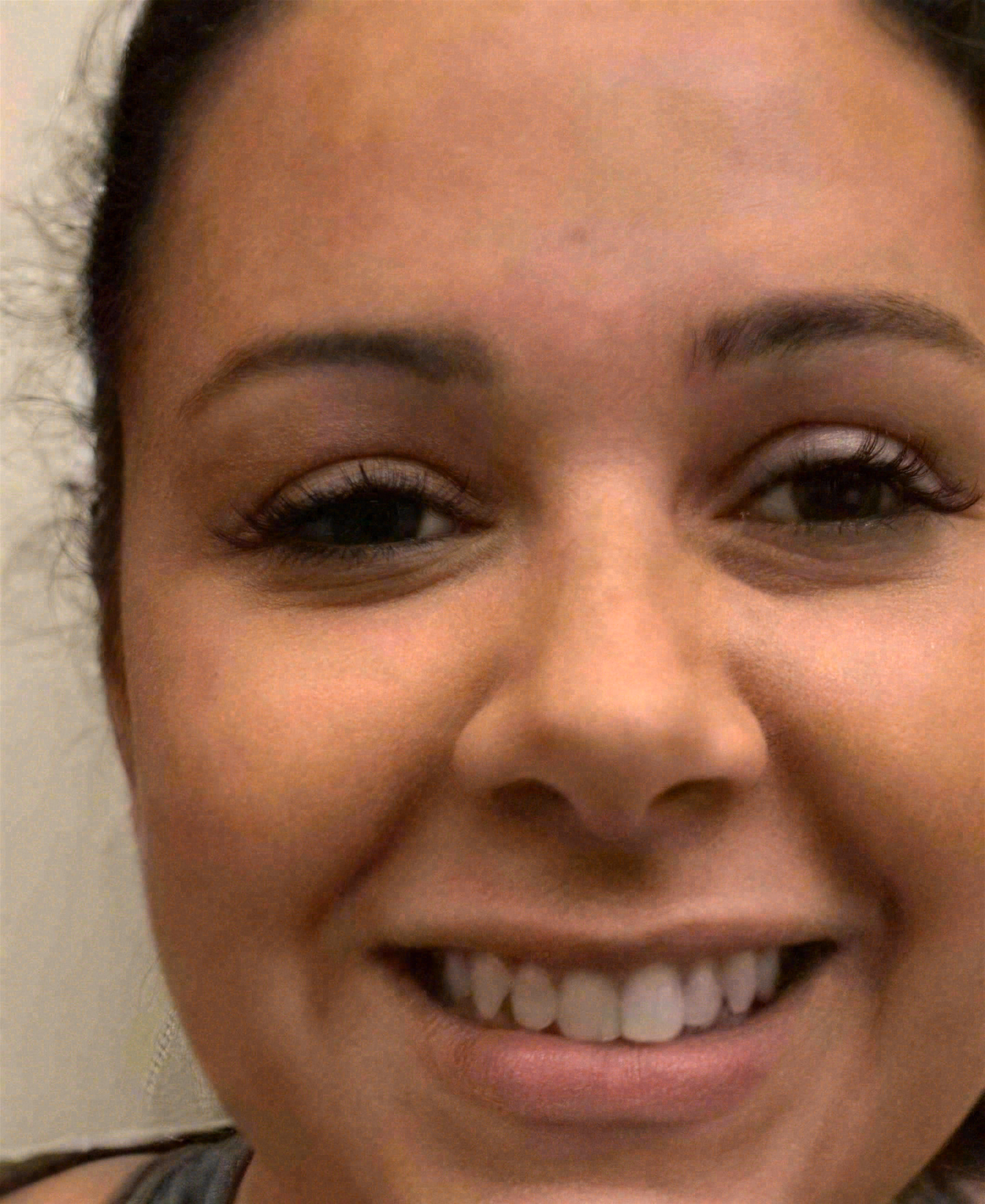 Before porcelain veneers at Sola Dental Spa