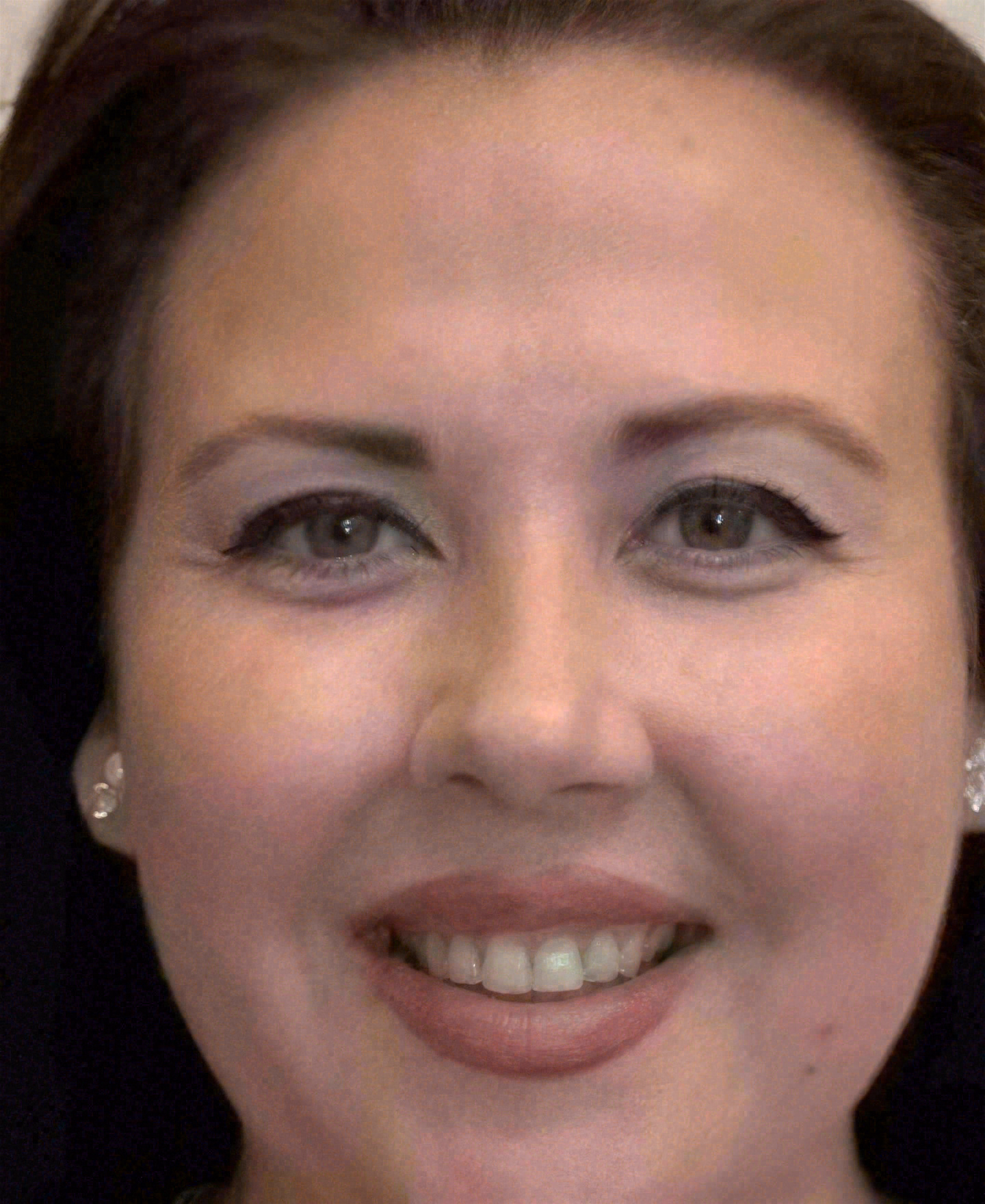 Before porcelain veneers at Sola Dental Spa