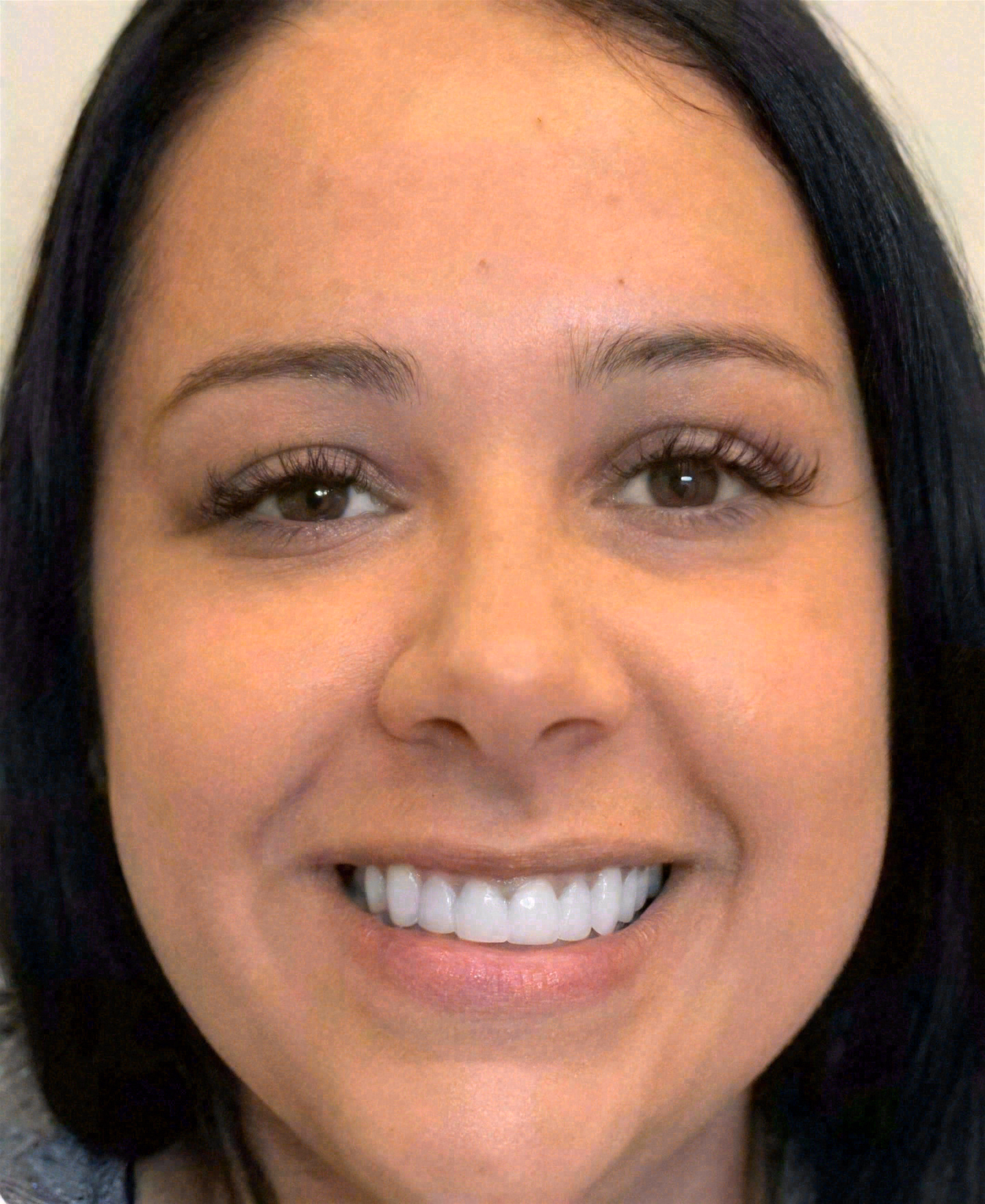 After porcelain veneers at Sola Dental Spa