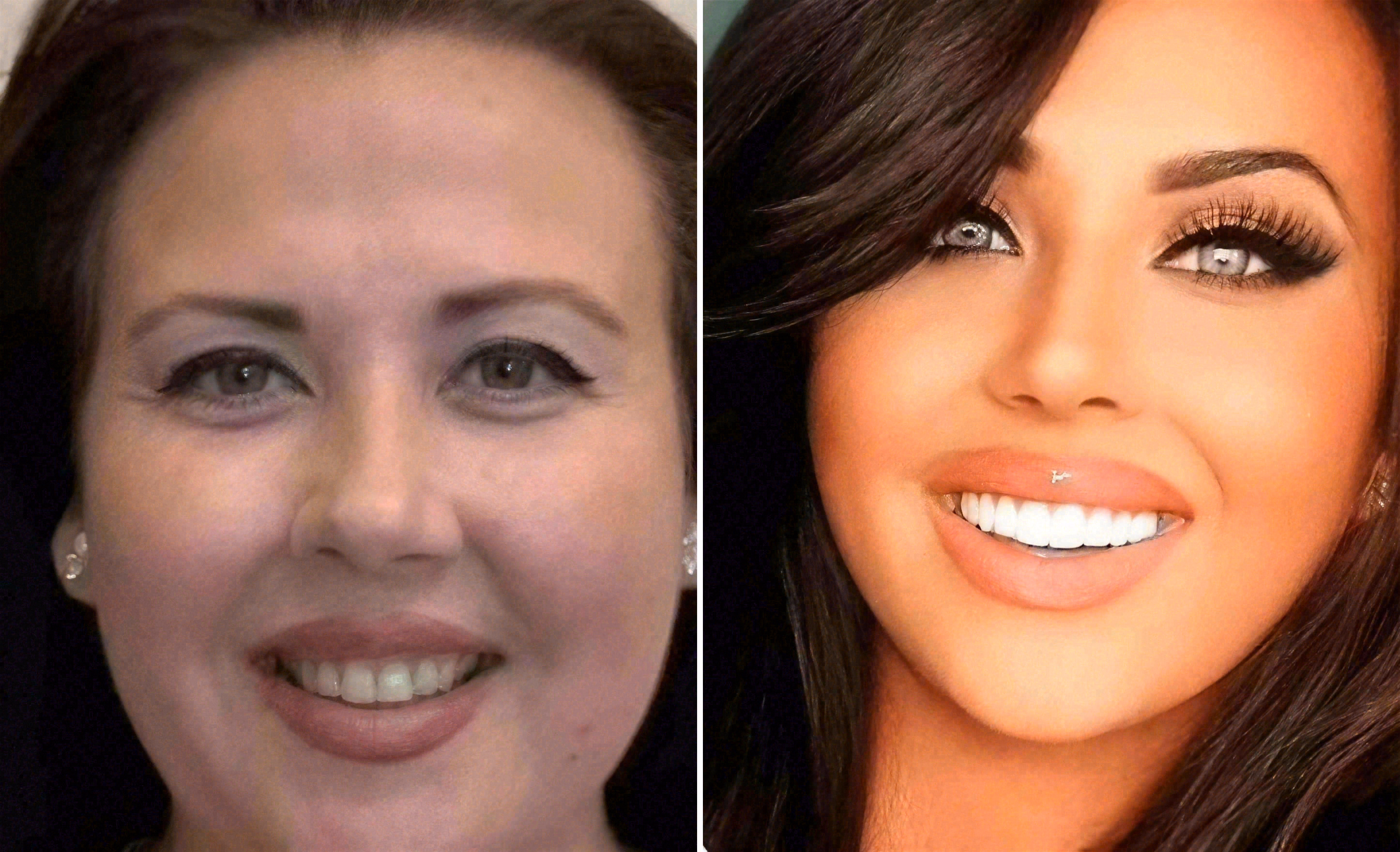 Before and after: porcelain veneers transformation at Sola Dental Spa