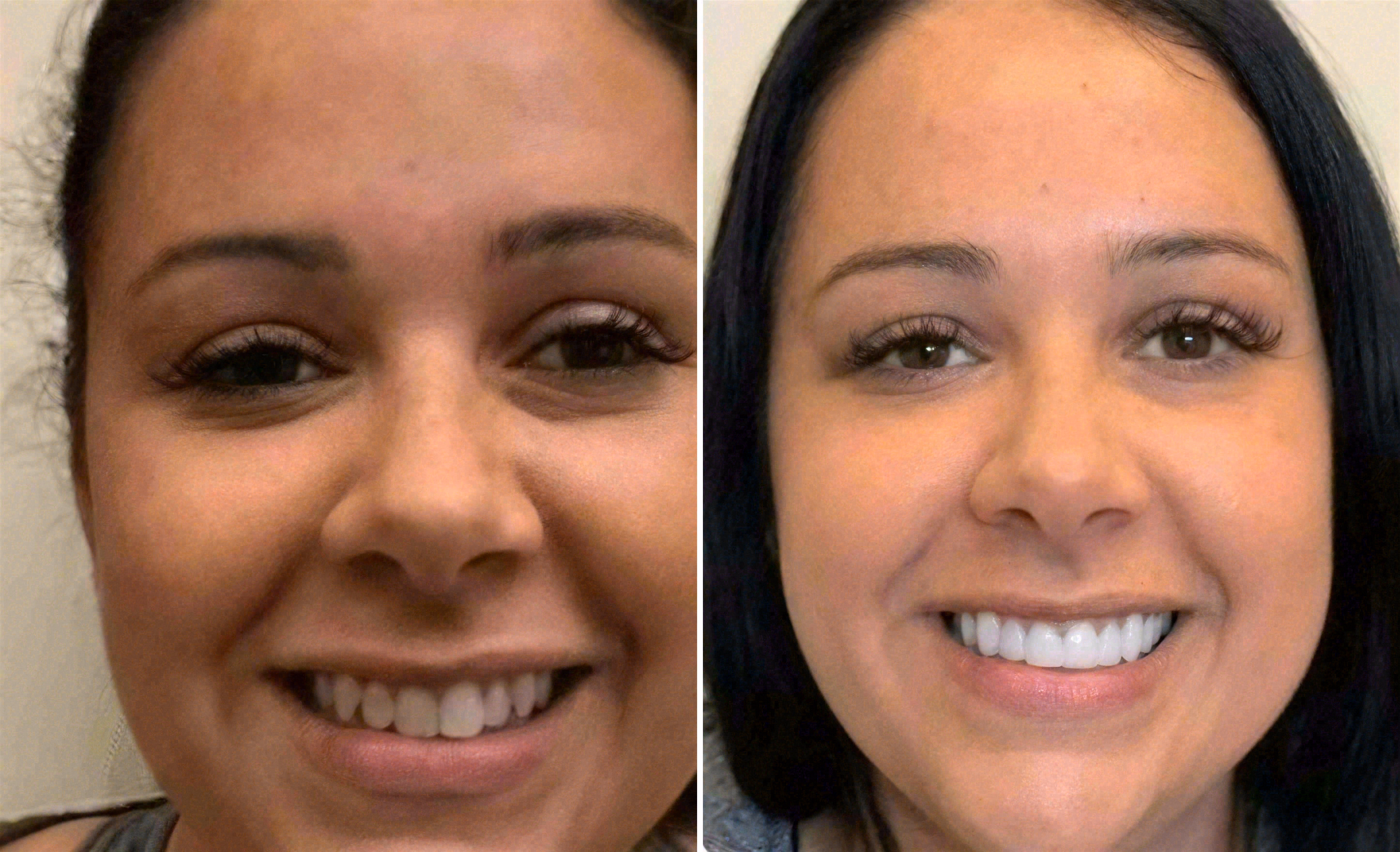 Before and after: porcelain veneers case at Sola Dental Spa