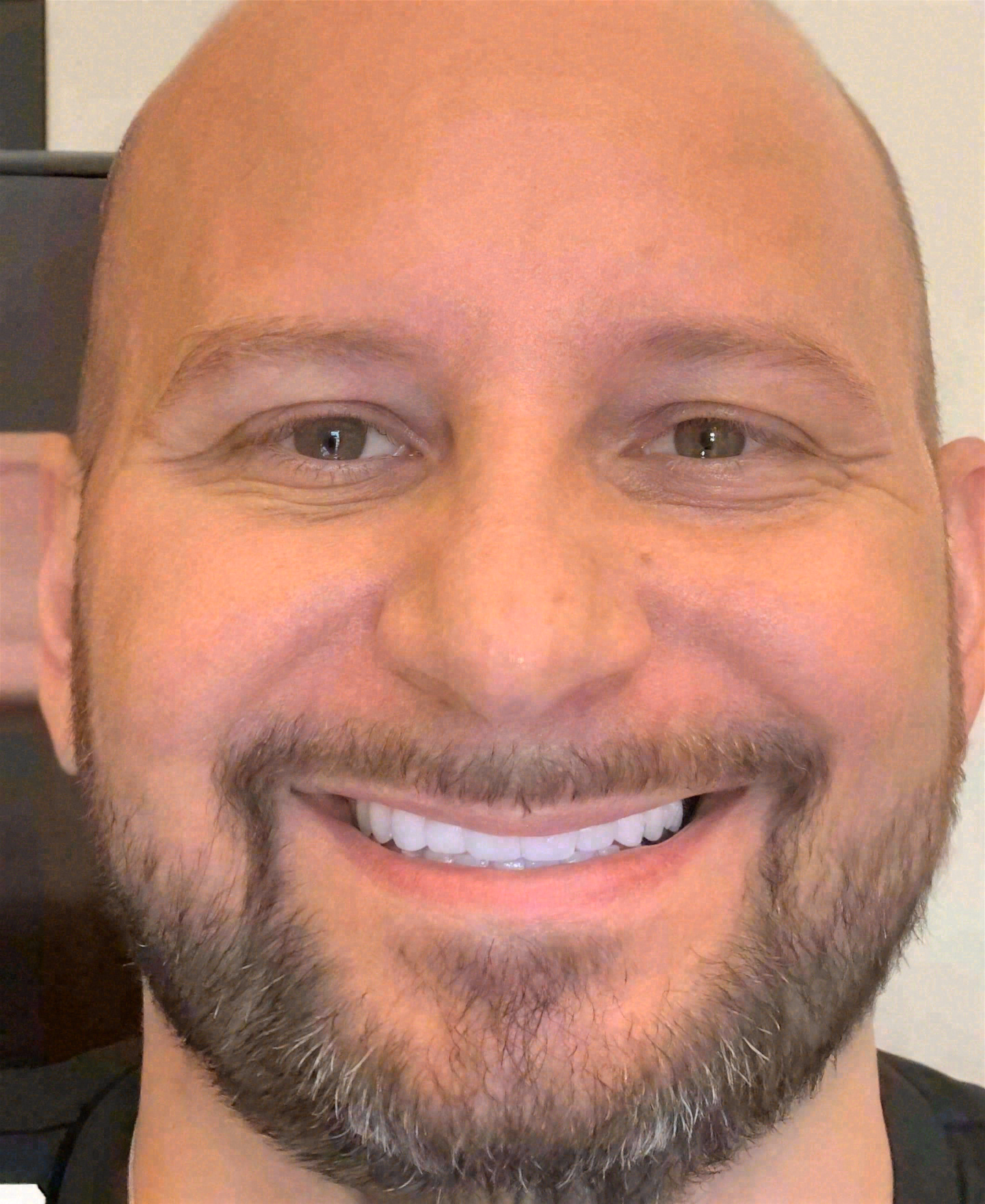 After porcelain veneers at Sola Dental Spa