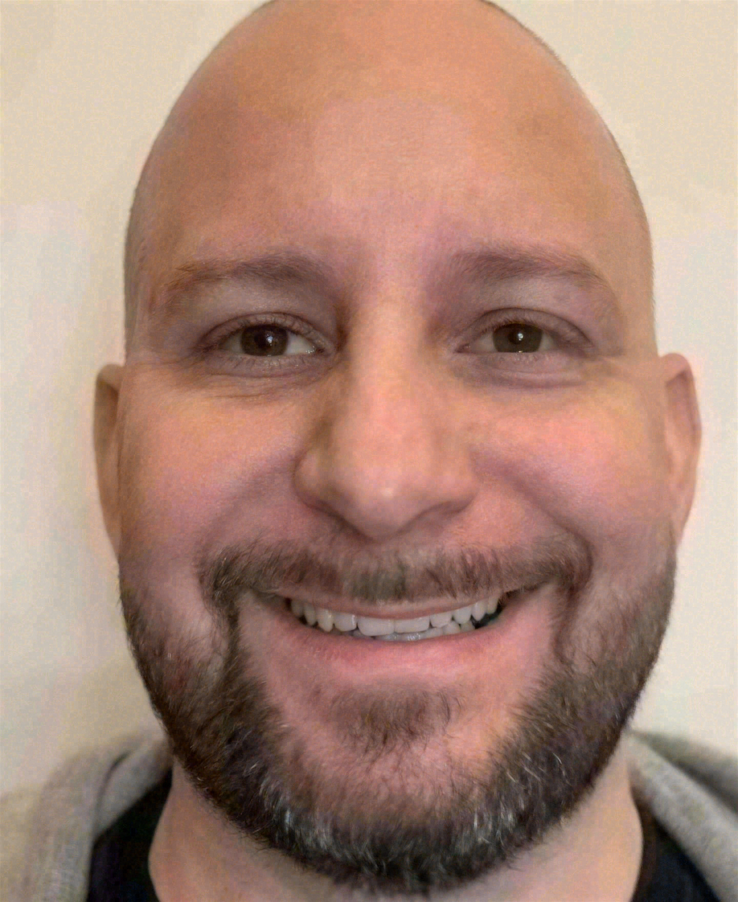 Before porcelain veneers at Sola Dental Spa