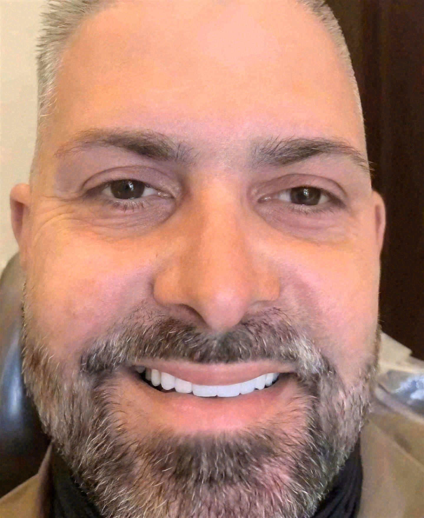 After porcelain veneers at Sola Dental Spa