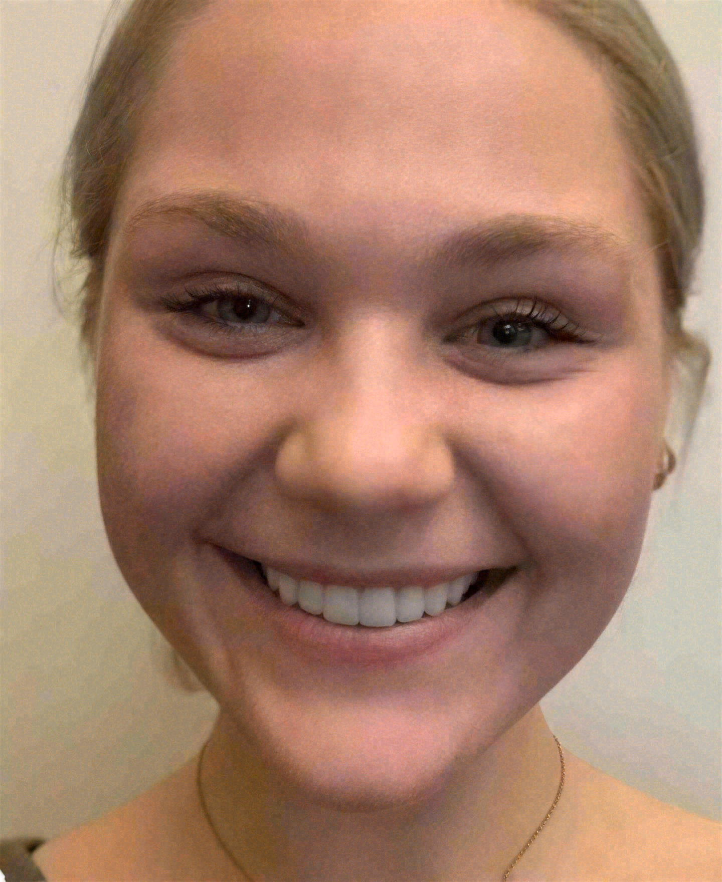 After smile makeover at Sola Dental Spa