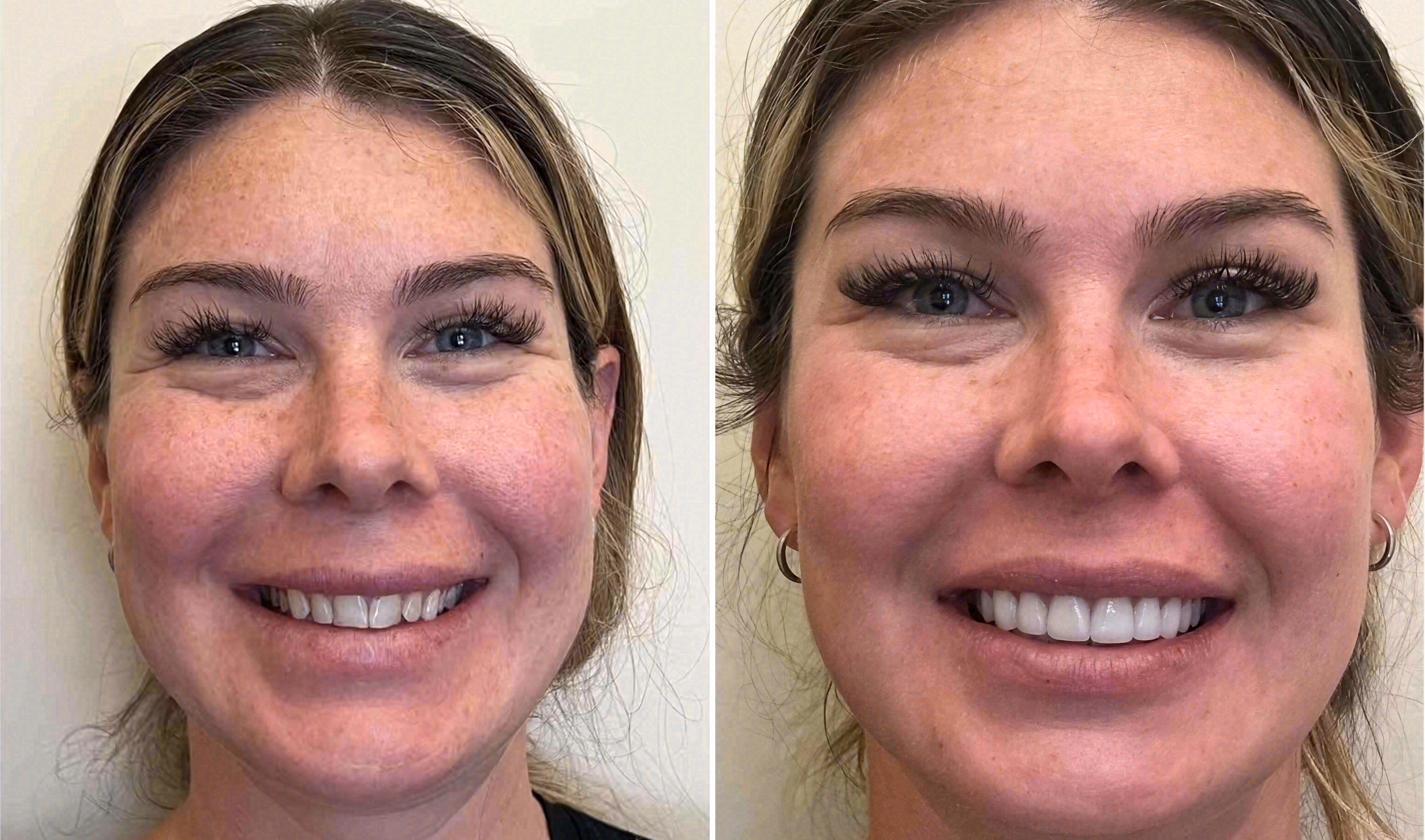 Before and after: porcelain veneers case at Sola Dental Spa
