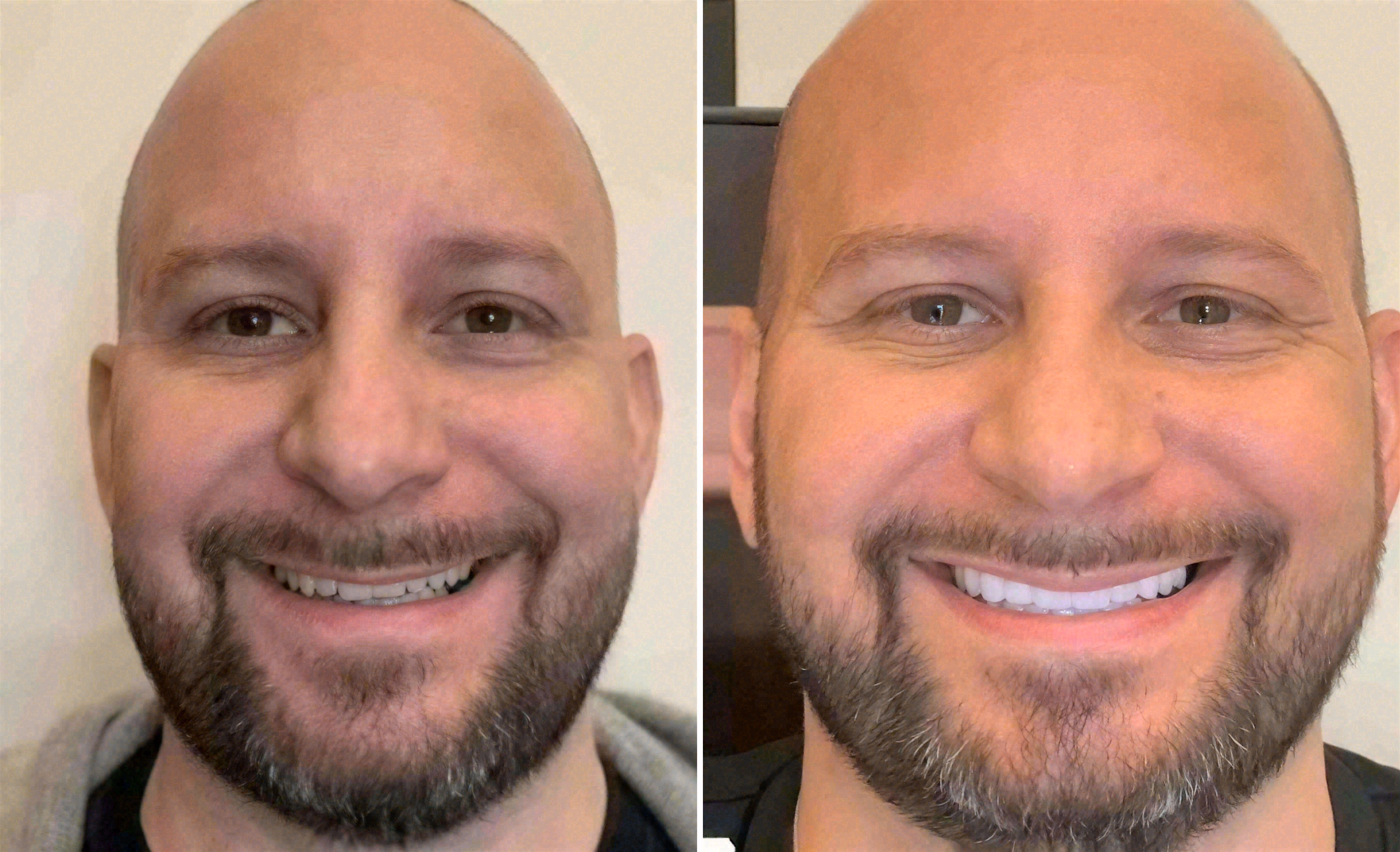 Close-up before and after: porcelain veneers at Sola Dental Spa