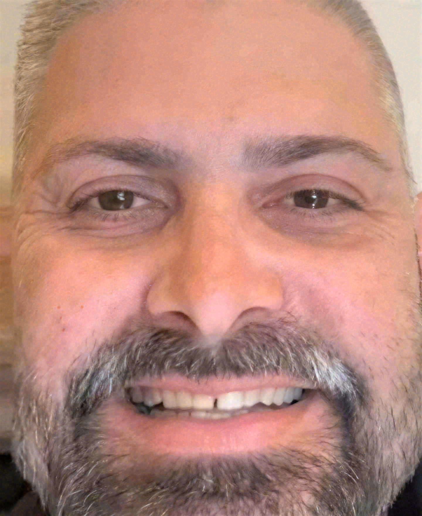 Before porcelain veneers at Sola Dental Spa