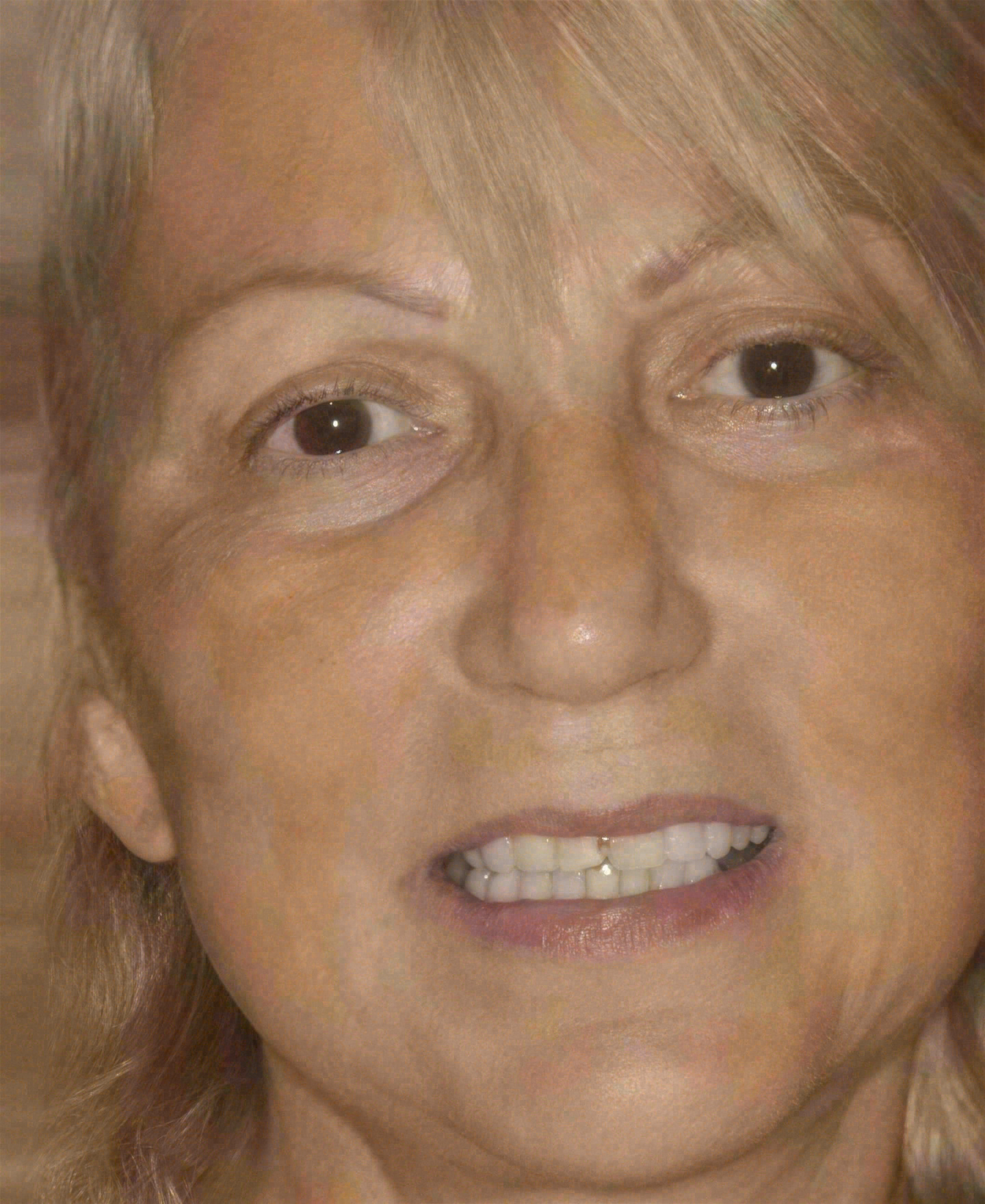 Before porcelain veneers at Sola Dental Spa