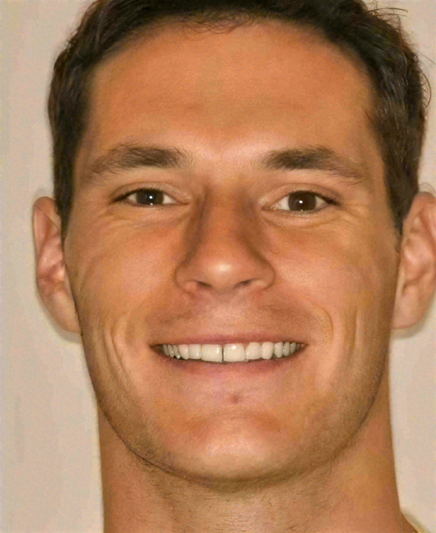 After porcelain veneers at Sola Dental Spa