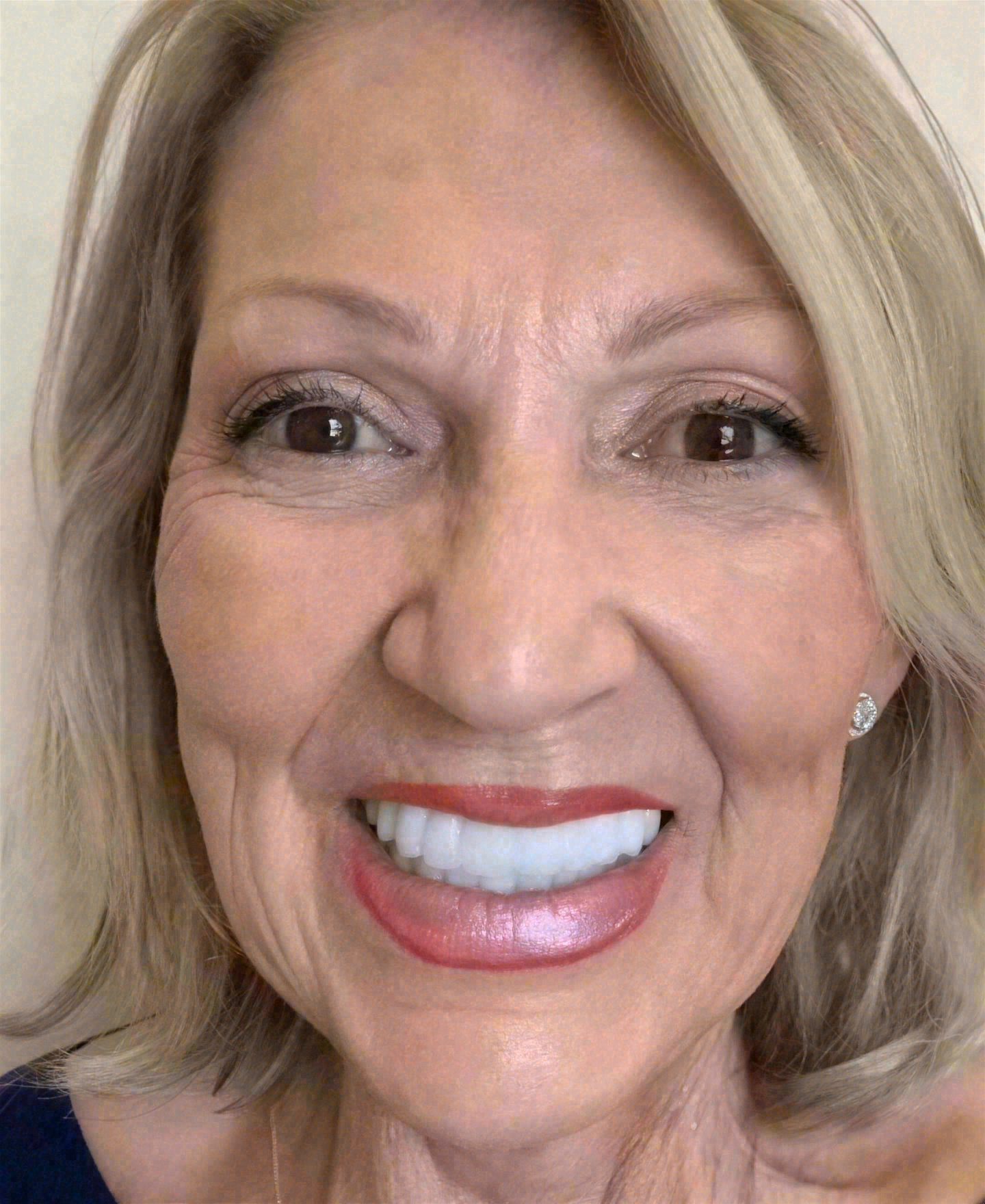 After porcelain veneers at Sola Dental Spa
