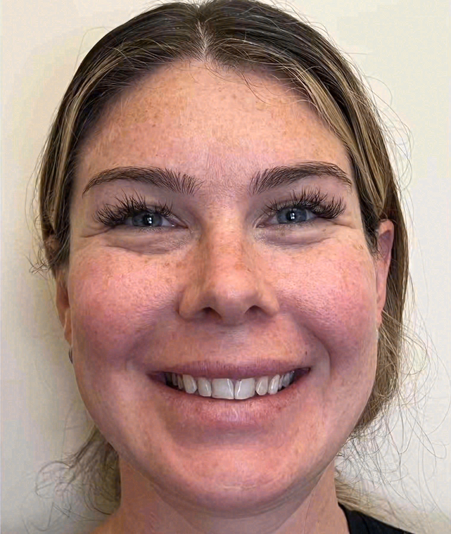 Before porcelain veneers at Sola Dental Spa