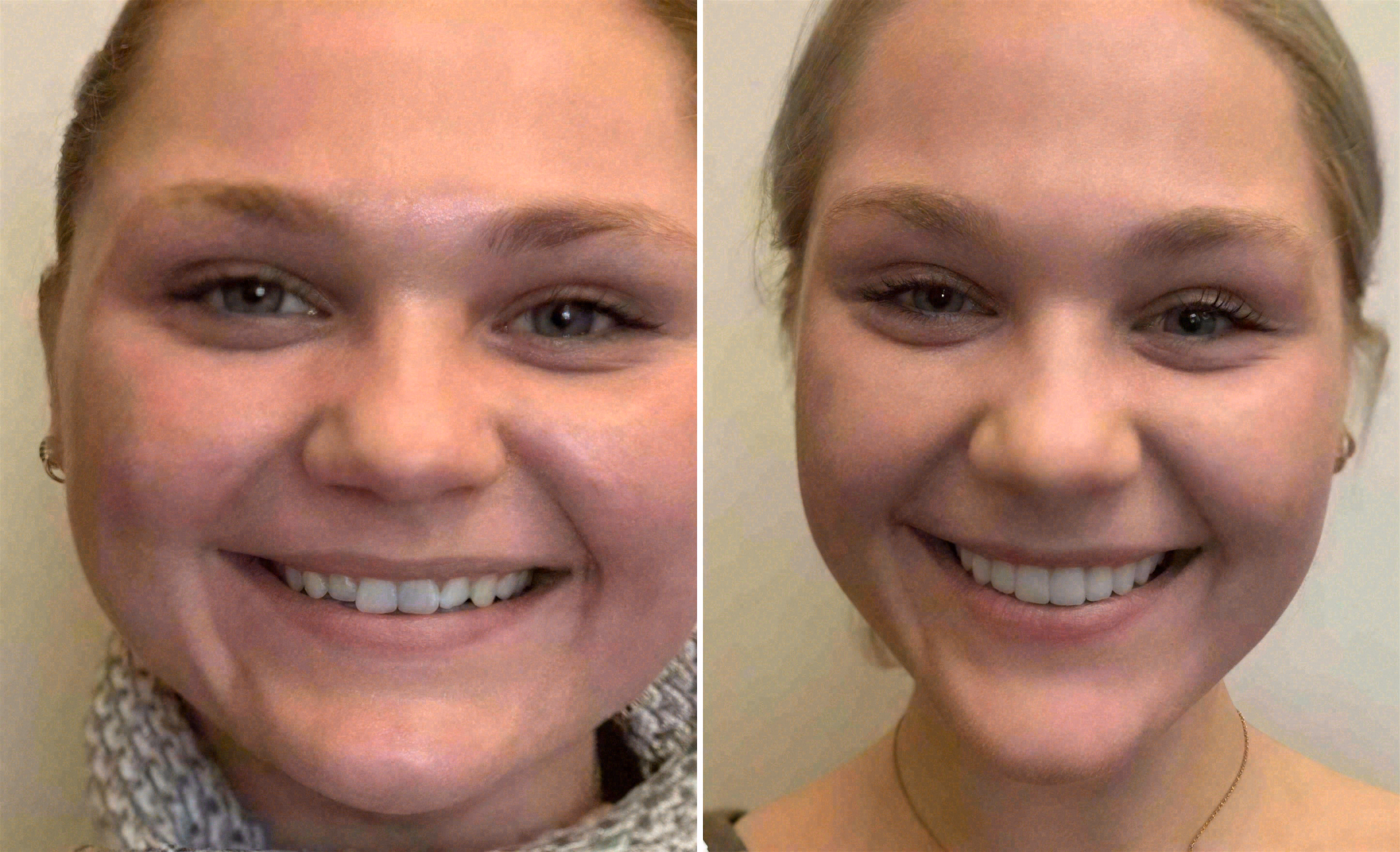 Before and after: smile makeover at Sola Dental Spa
