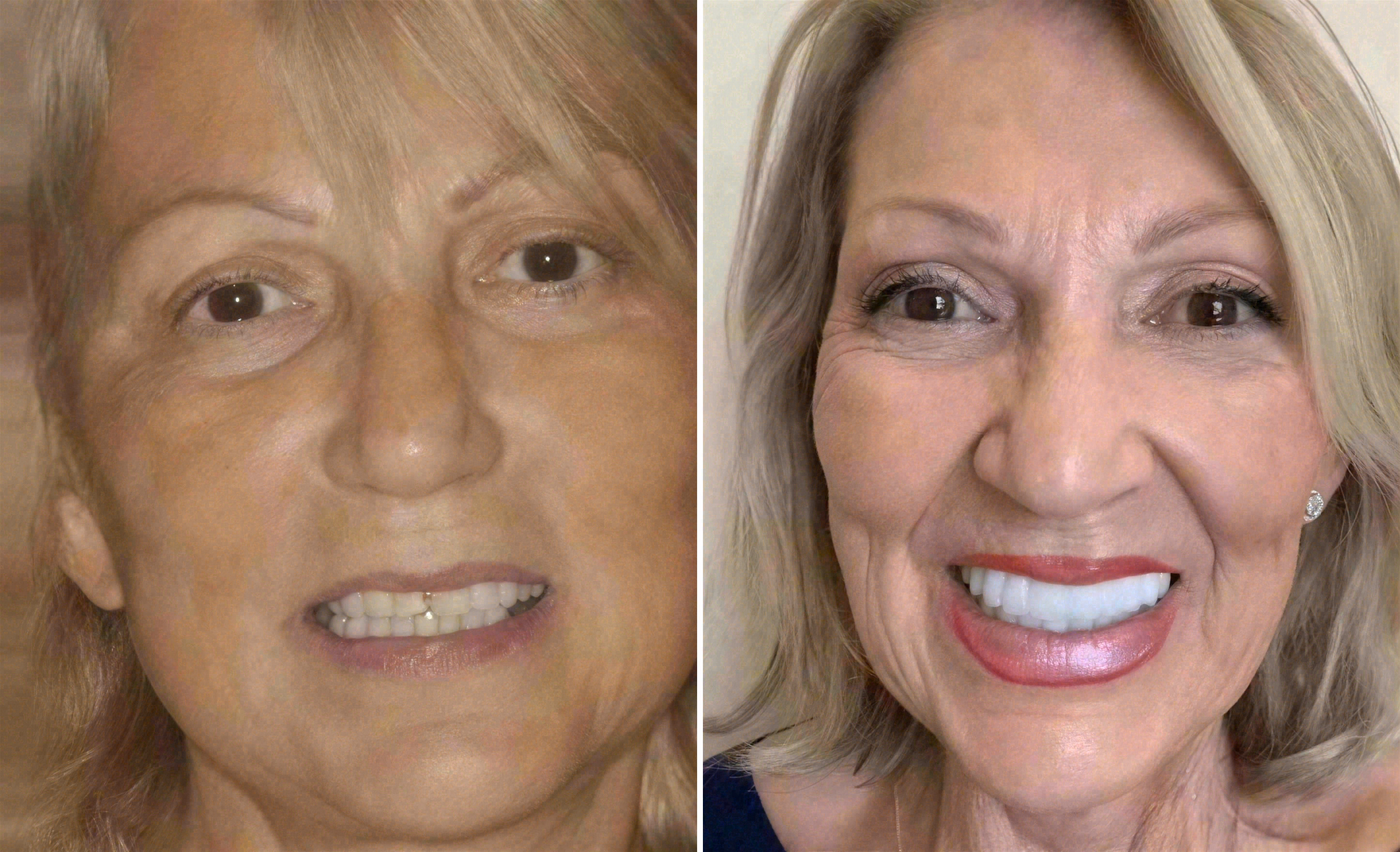 Before and after: porcelain veneers case at Sola Dental Spa