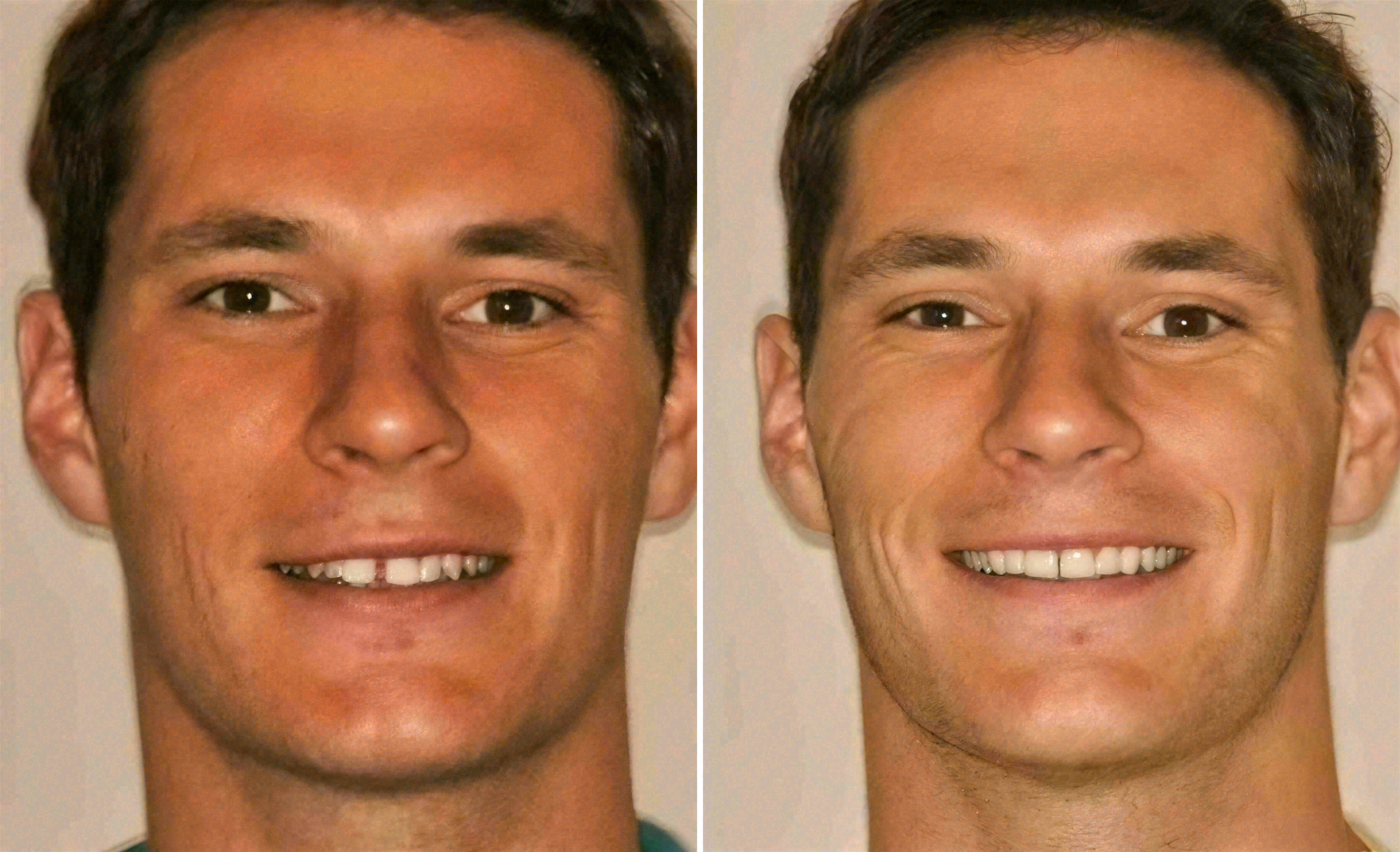 Before and after: porcelain veneers and whitening case at Sola Dental Spa