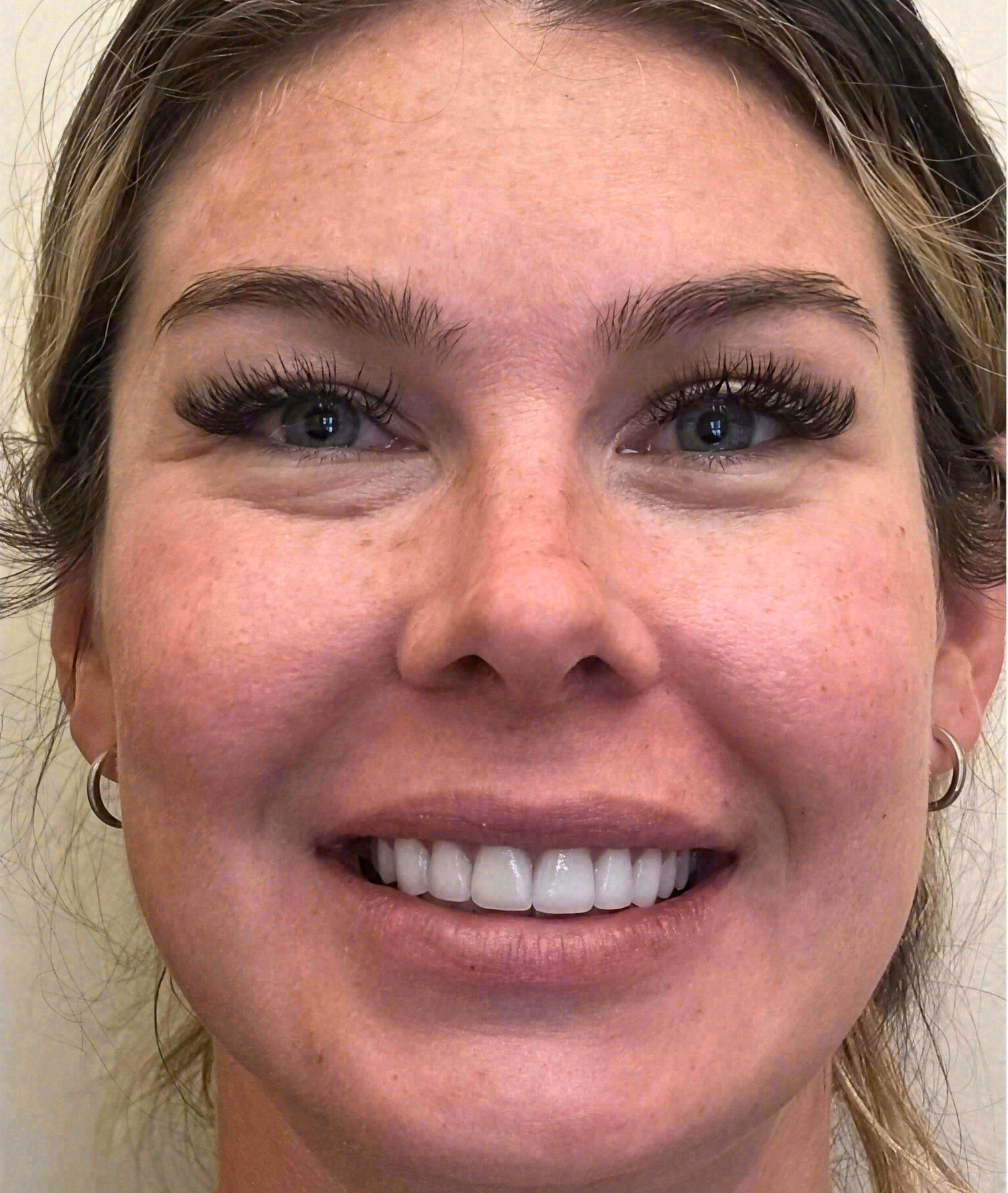 After porcelain veneers at Sola Dental Spa