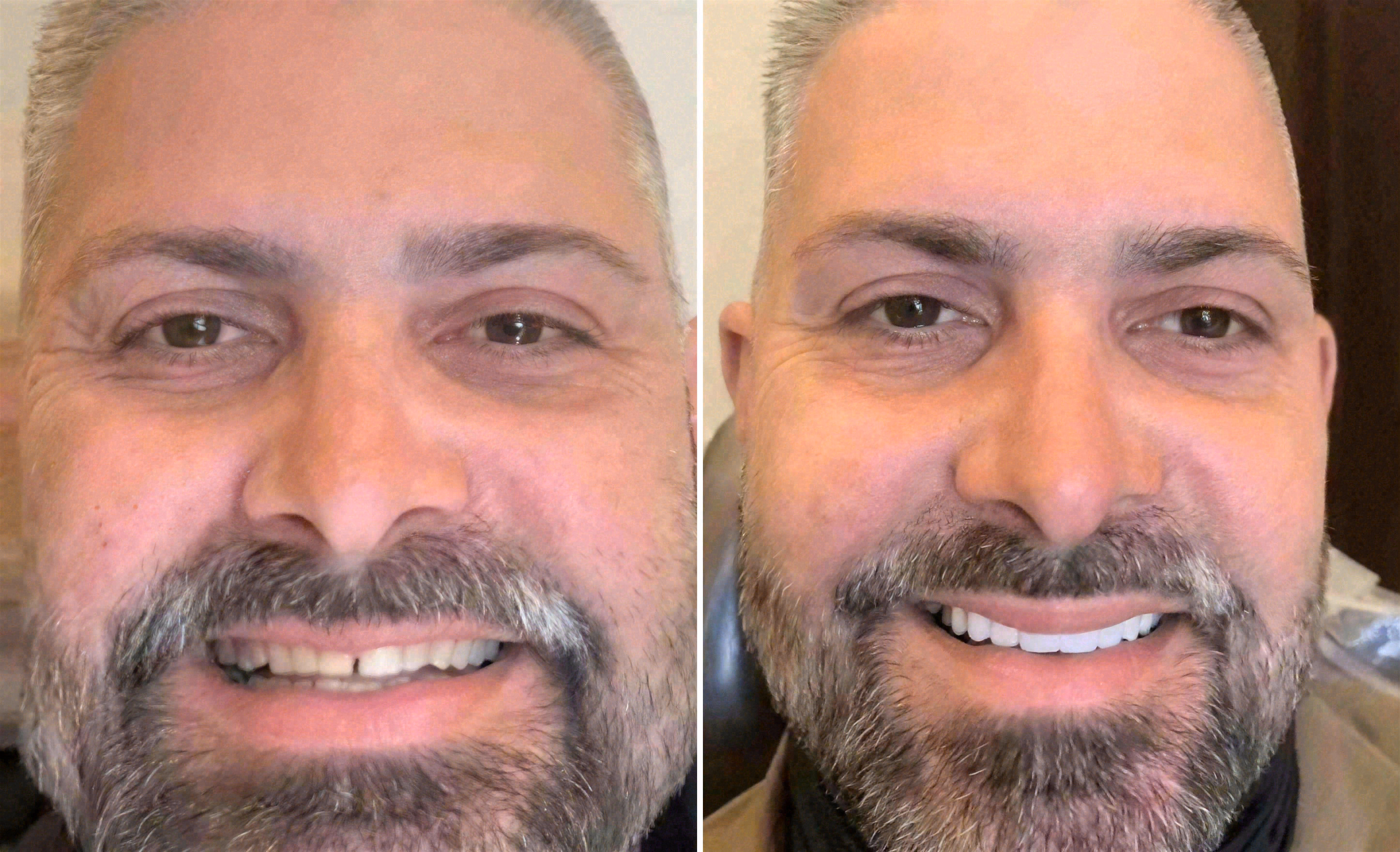Before and after: porcelain veneers case at Sola Dental Spa