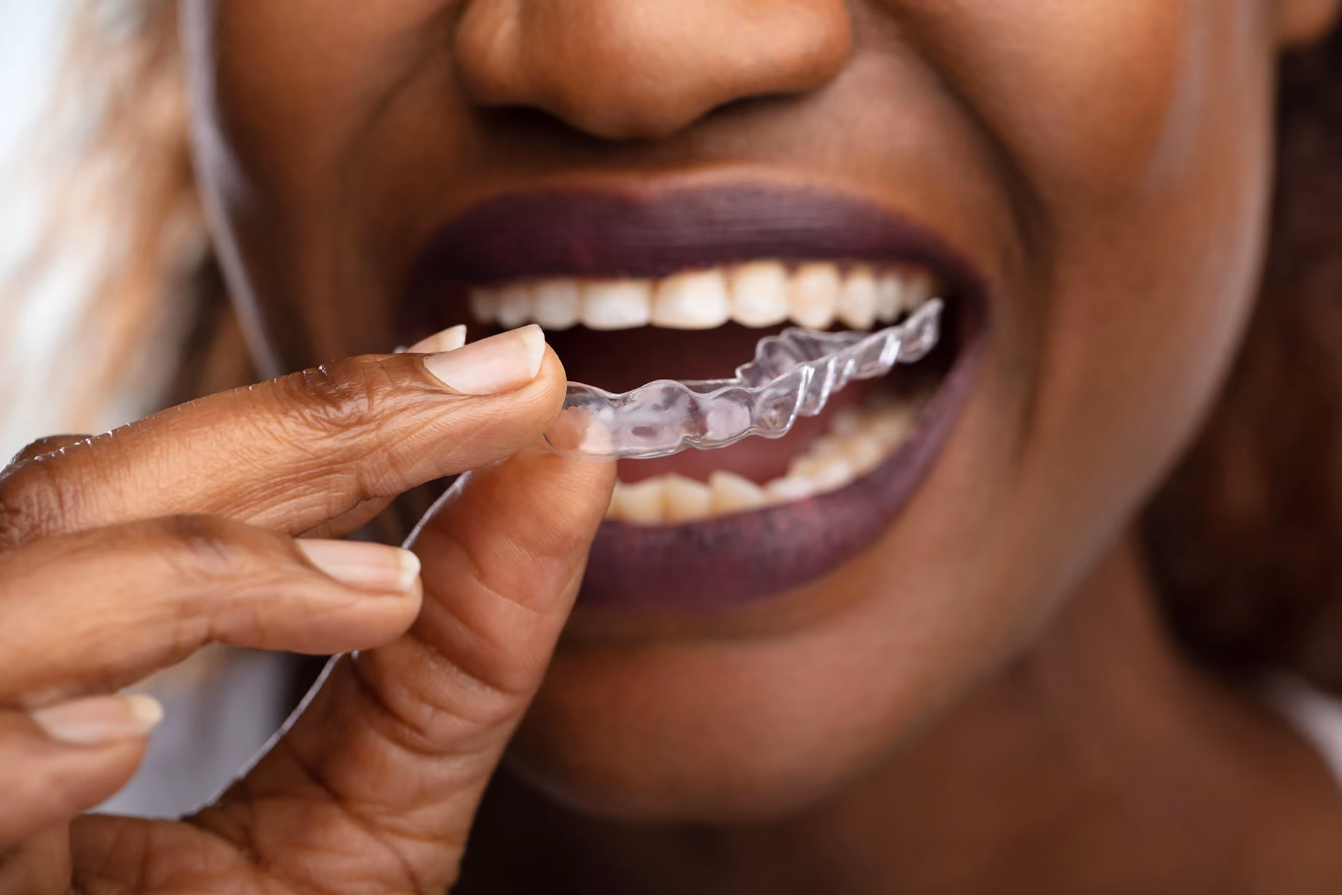 Clear Aligners