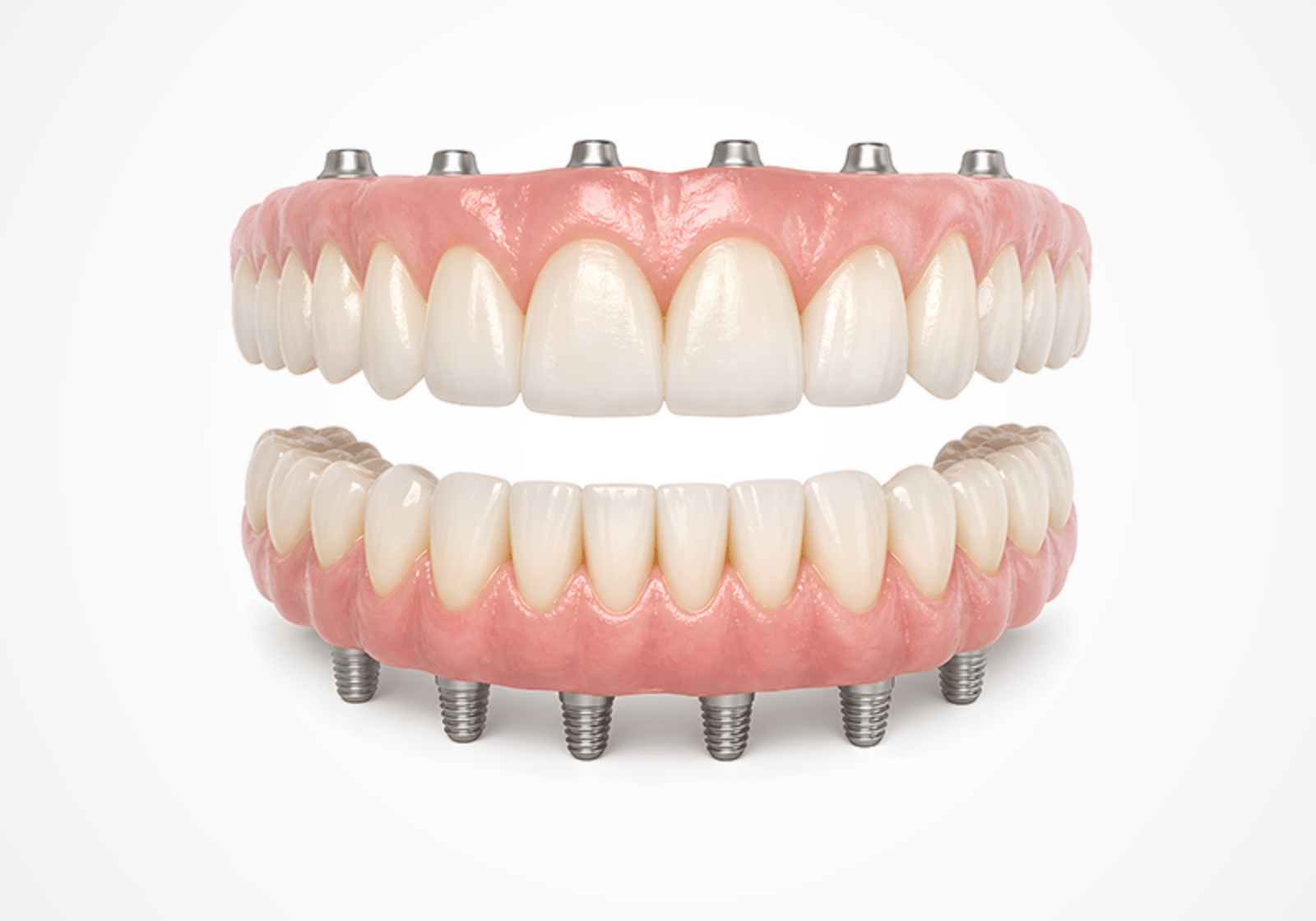 Full Mouth Restoration