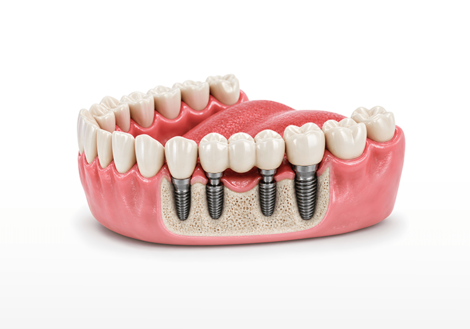 Implant Bridges