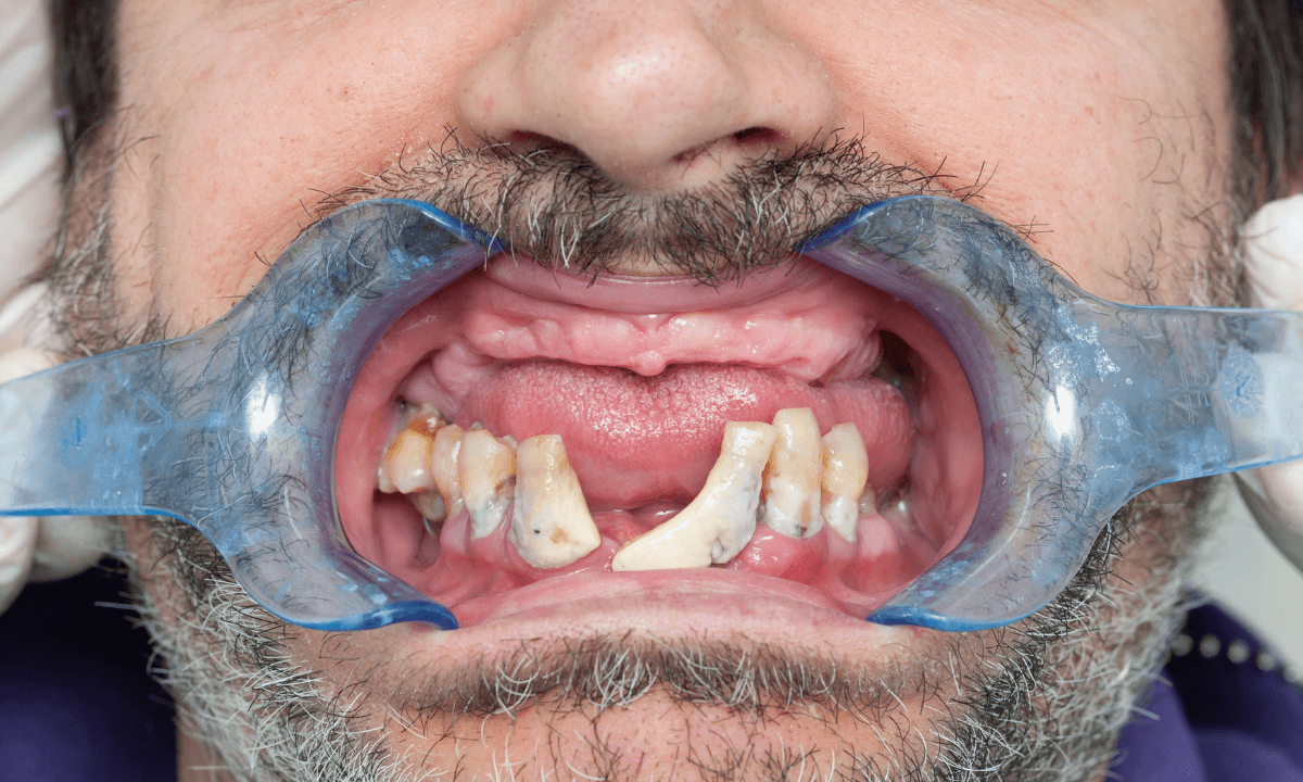 In house teeth replacement