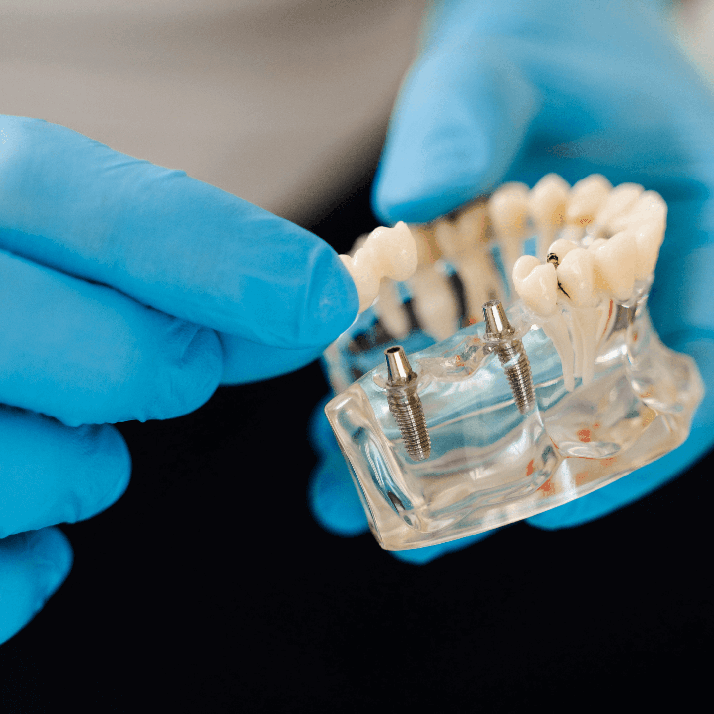 dental implants in Temecula