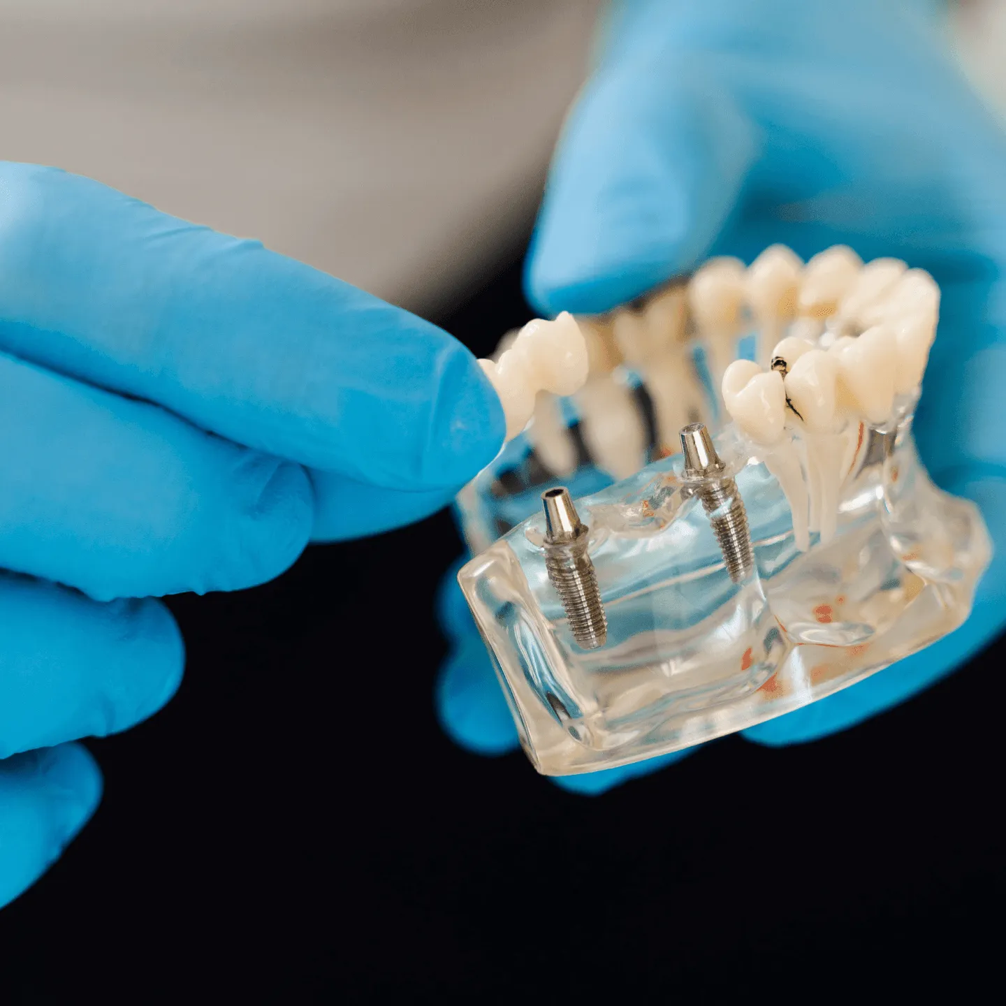 dental implants in Temecula
