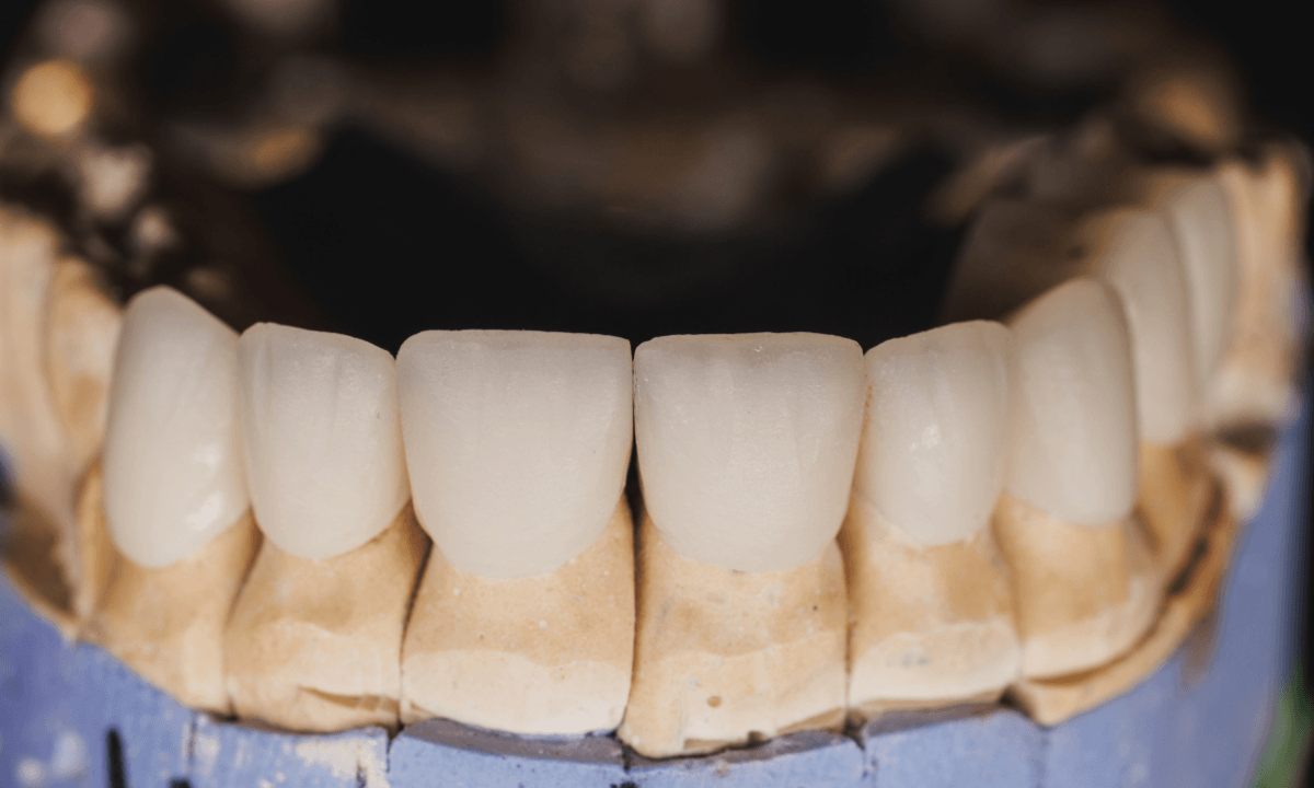 Full Crown & Veneers sevices