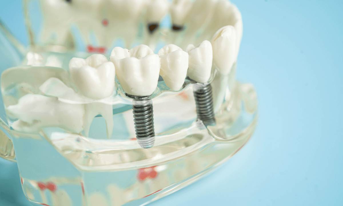Dental implants