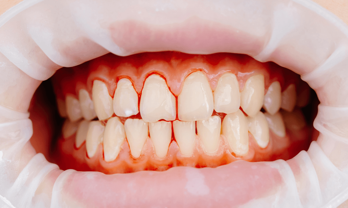 Dental implants