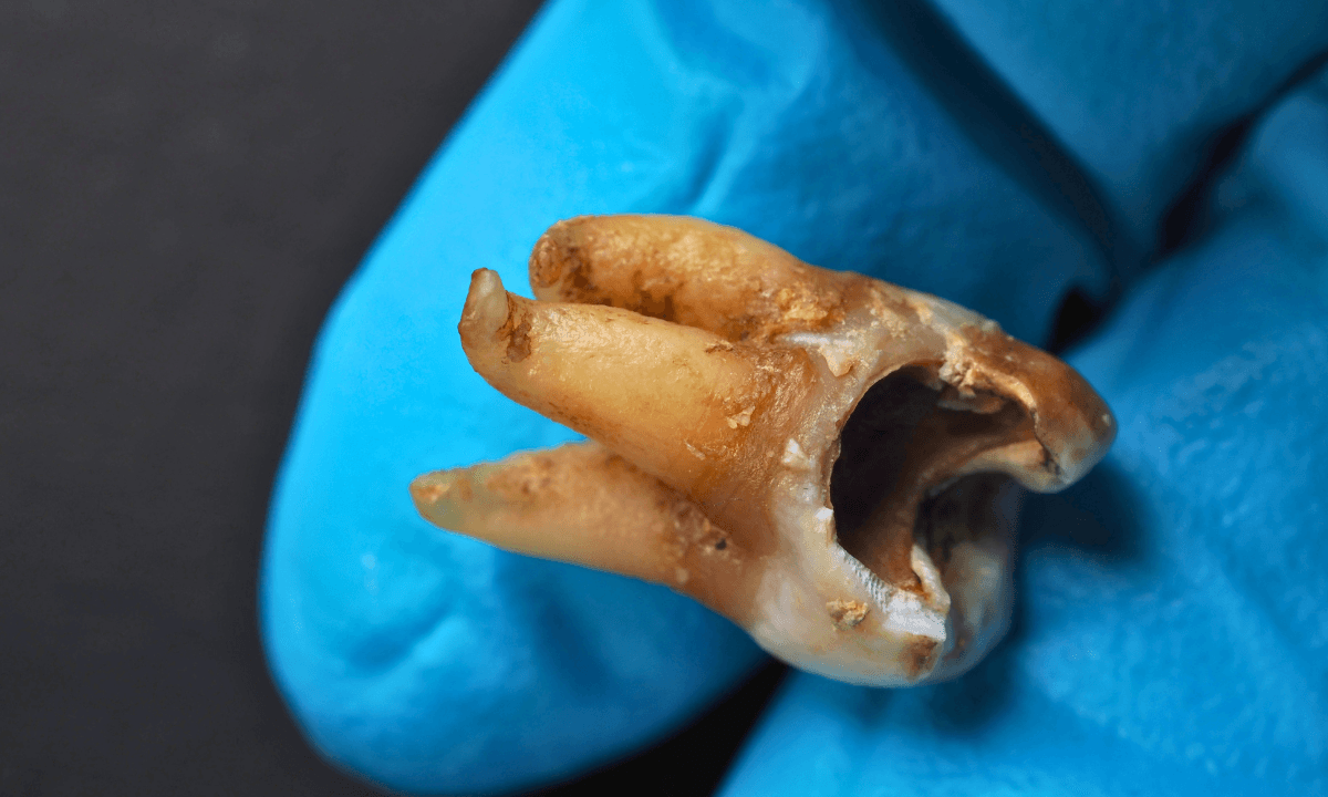 Emergency Dentist Temecula