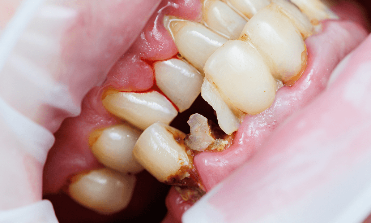 Temecula Emergency Dentist
