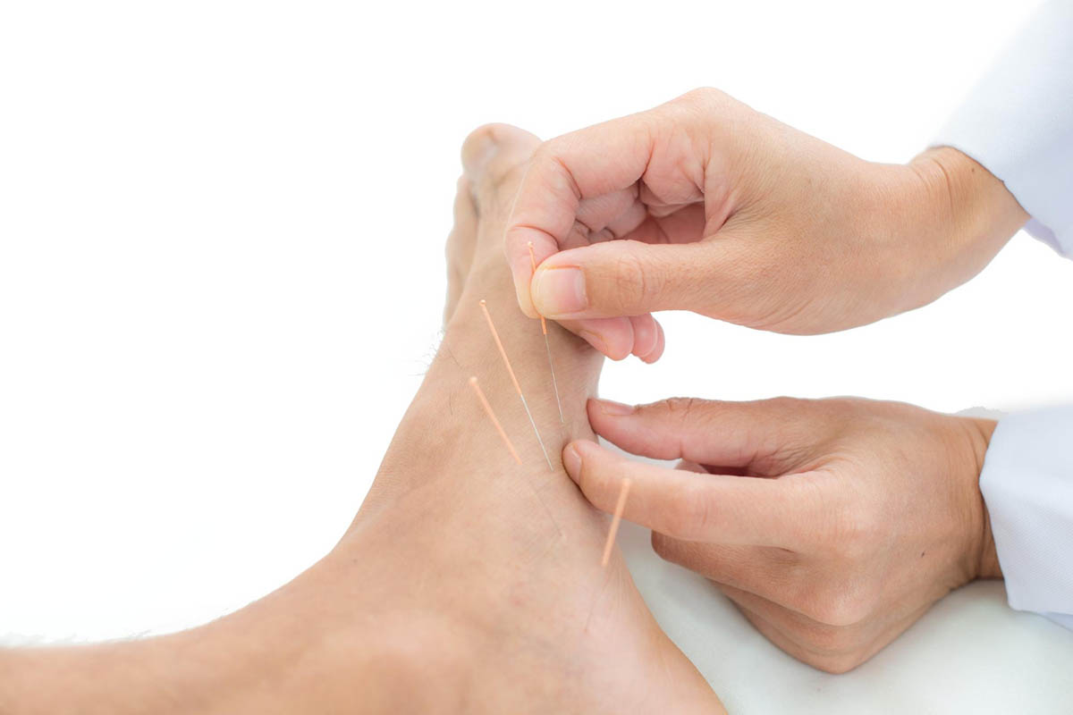 Discover the Benefits of Dry Needling with Backcountry Physical Therapy