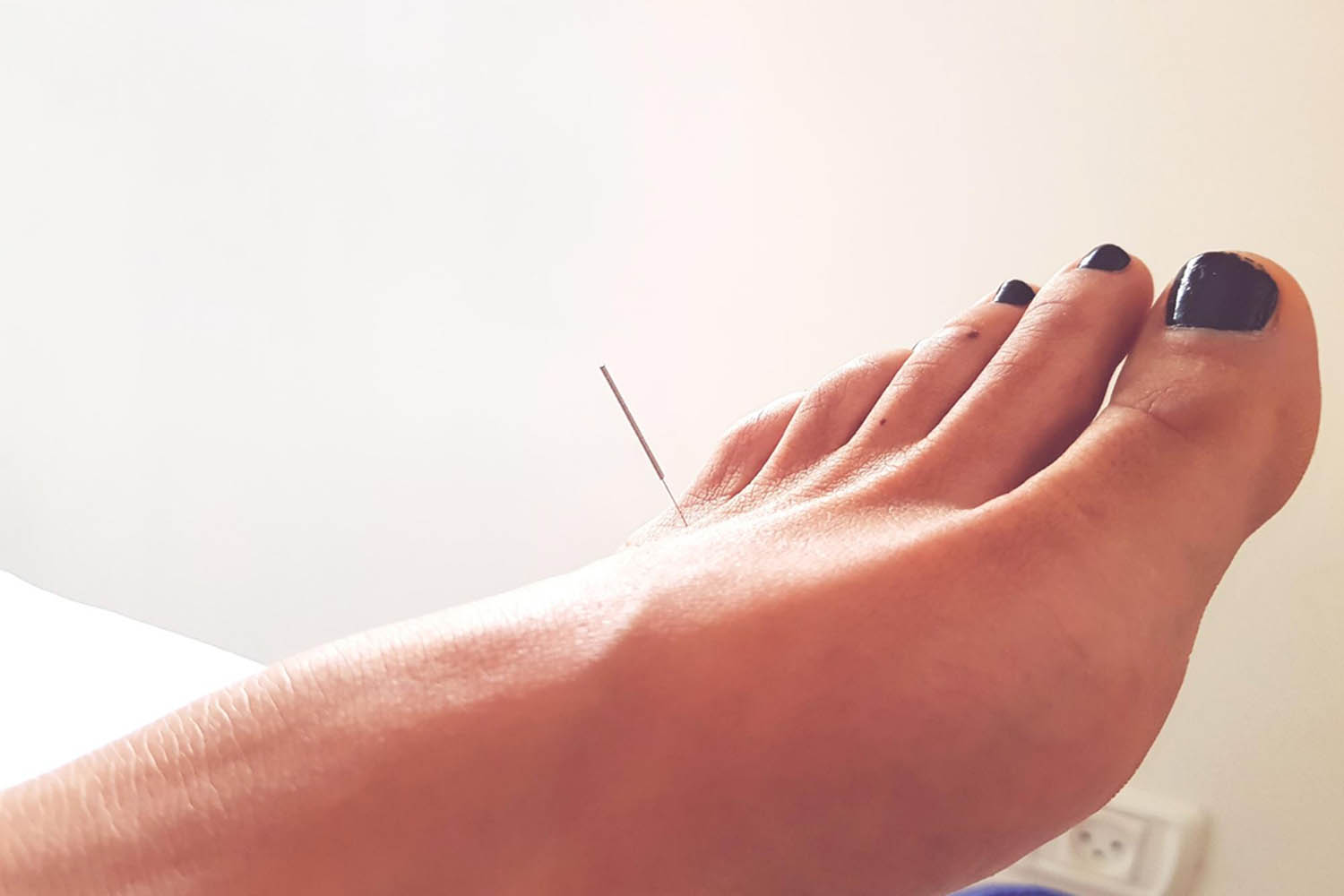 What is Dry Needling for Plantar Fasciitis?