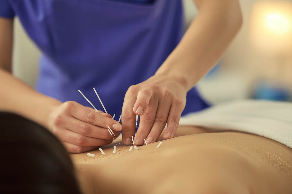 Should You Try Dry Needling?