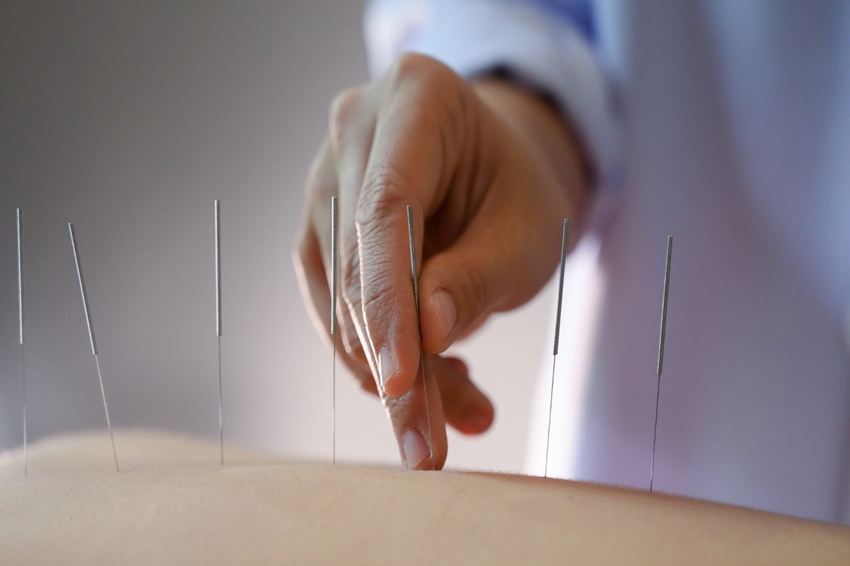 The Pros and Cons of Dry Needling