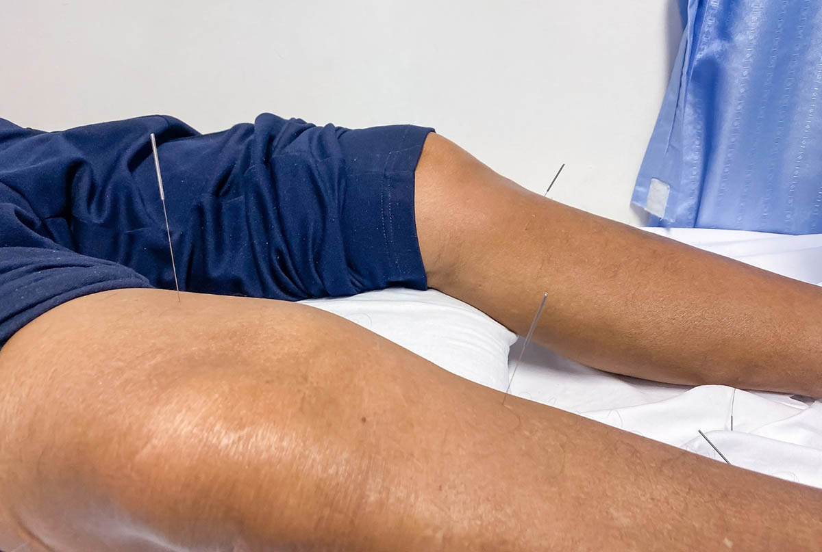 How Dry Needling Works for Knee Pain