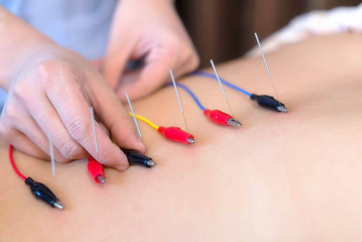 Benefits of Dry Needling for Back Pain