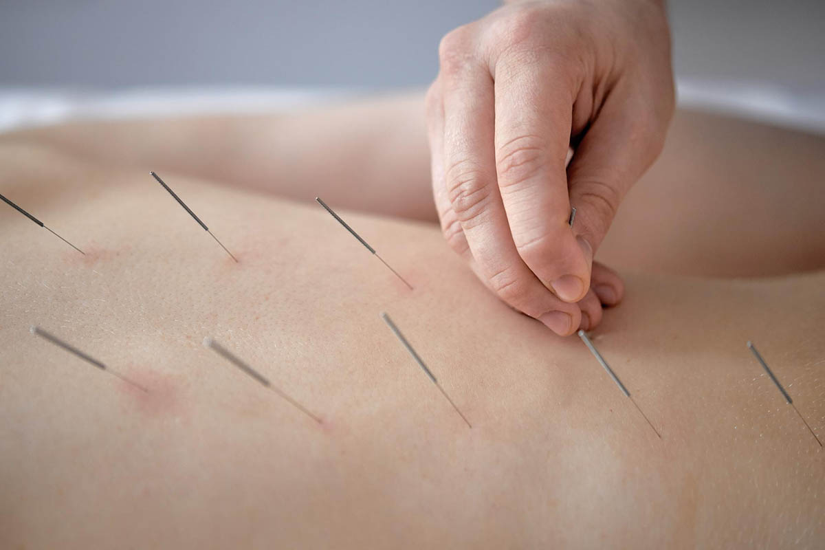 How Many Dry Needling Sessions Are Needed