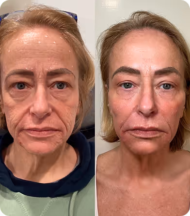 Side-by-side images of a woman showing facial before and after cosmetic skin treatment.