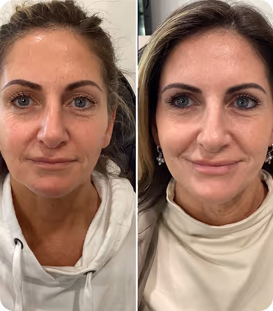 Before and after close-up photos of a woman showing skin and facial improvements.